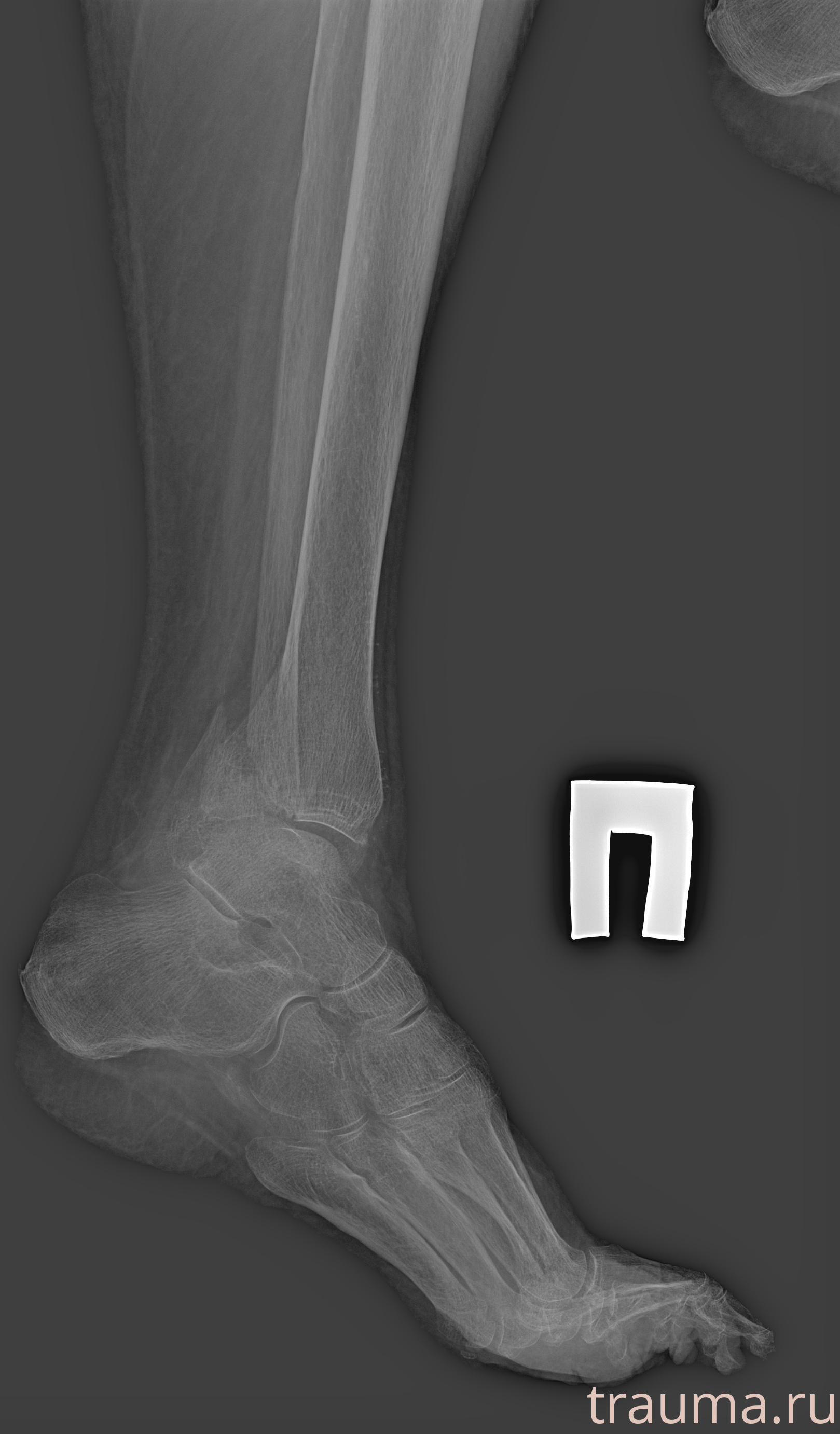 Рентген на дому: по вашему адресу приезжает врач-рентгенолог, травматолог-ортопед с мобильным рентгеновским аппаратом, проводит диагностику травмы или заболевания, делает необходимые рентгенограммы, дает рекомендации по дальнейшему лечению. Получить качественные снимки в домашних условиях возможно благодаря уникальной методике, разработанной МосРентген Центром для института  Склифосовского