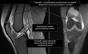 Роль МРТ и УЗИ в оценке структур коленного сустава при внутрисуставных переломах Роль МРТ и УЗИ в оценке структур коленного сустава при внутрисуставных переломах
