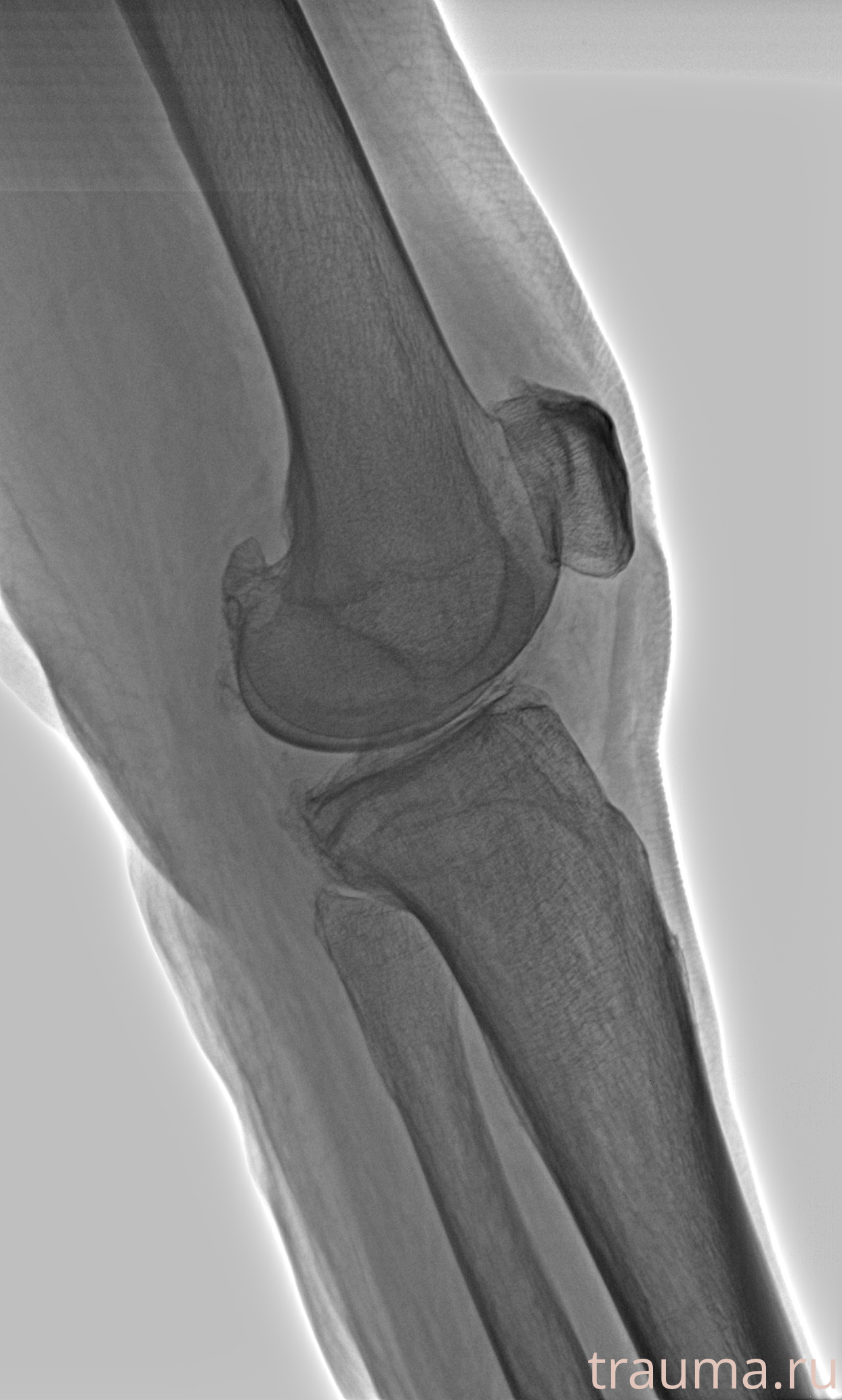 Рентген на дому: по вашему адресу приезжает врач-рентгенолог, травматолог-ортопед с мобильным рентгеновским аппаратом, проводит диагностику травмы или заболевания, делает необходимые рентгенограммы, дает рекомендации по дальнейшему лечению. Получить качественные снимки в домашних условиях возможно благодаря уникальной методике, разработанной МосРентген Центром для института  Склифосовского