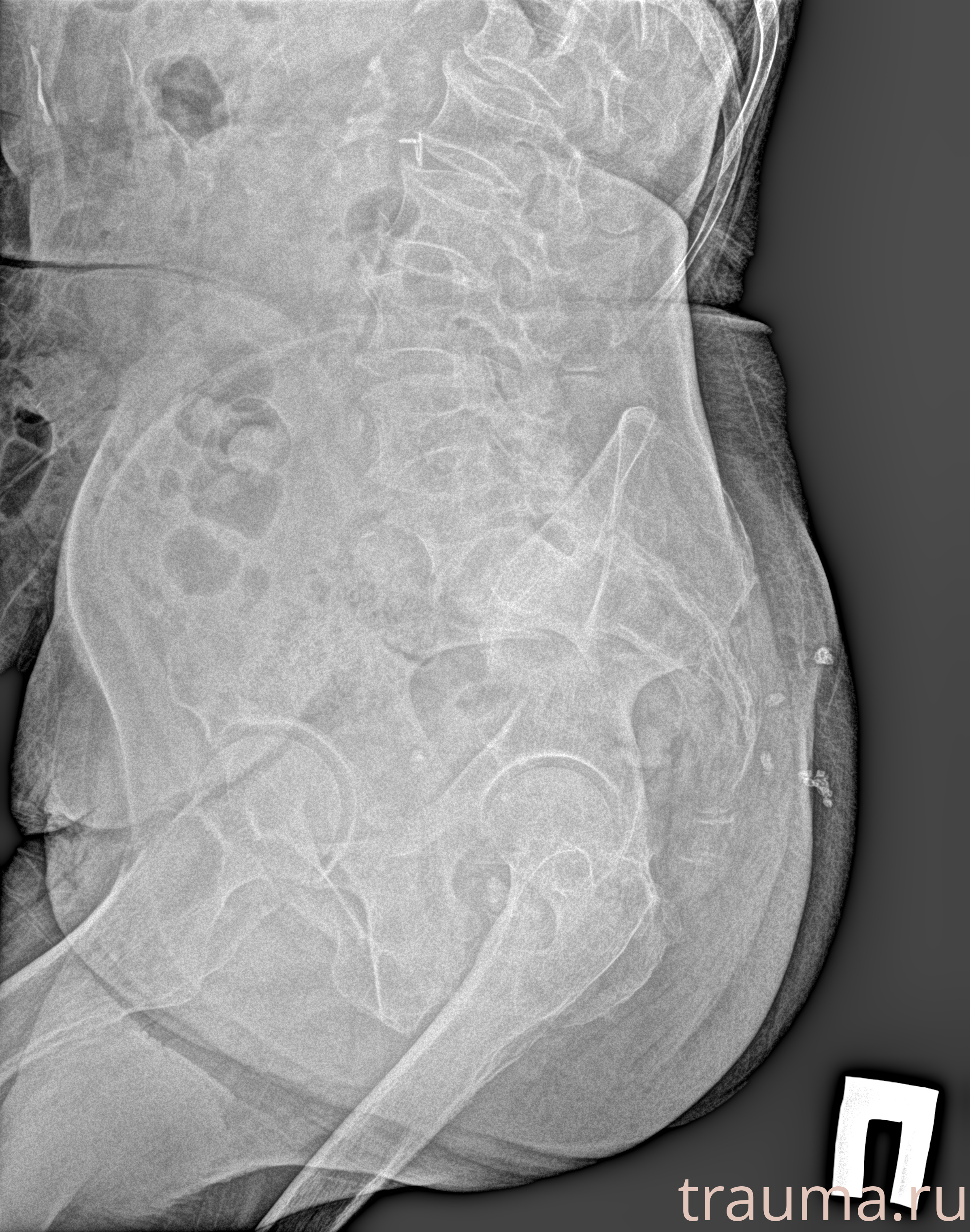 Рентген на дому: по вашему адресу приезжает врач-рентгенолог, травматолог-ортопед с мобильным рентгеновским аппаратом, проводит диагностику травмы или заболевания, делает необходимые рентгенограммы, дает рекомендации по дальнейшему лечению. Получить качественные снимки в домашних условиях возможно благодаря уникальной методике, разработанной МосРентген Центром для института  Склифосовского