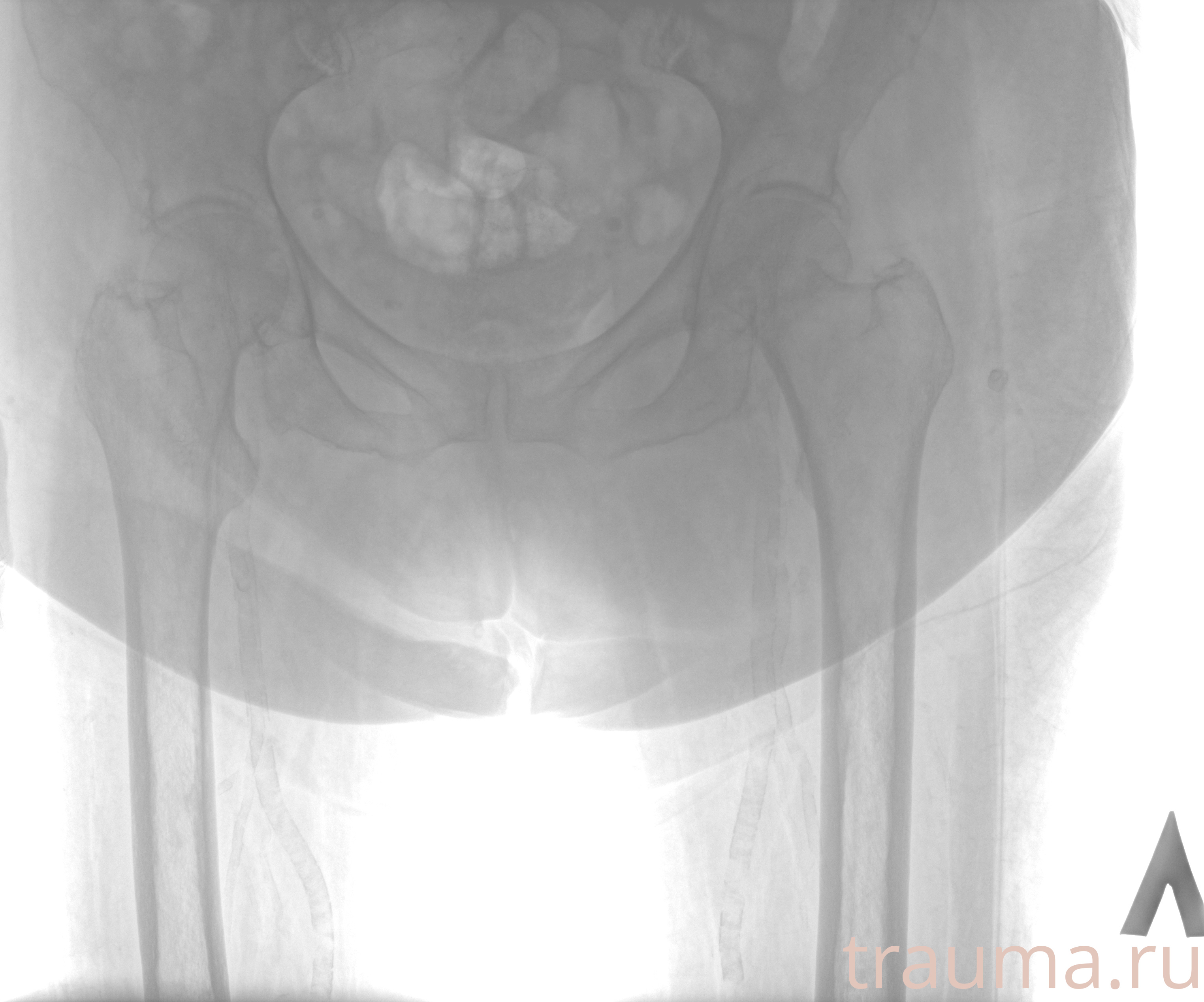 Рентген на дому: по вашему адресу приезжает врач-рентгенолог, травматолог-ортопед с мобильным рентгеновским аппаратом, проводит диагностику травмы или заболевания, делает необходимые рентгенограммы, дает рекомендации по дальнейшему лечению. Получить качественные снимки в домашних условиях возможно благодаря уникальной методике, разработанной МосРентген Центром для института  Склифосовского