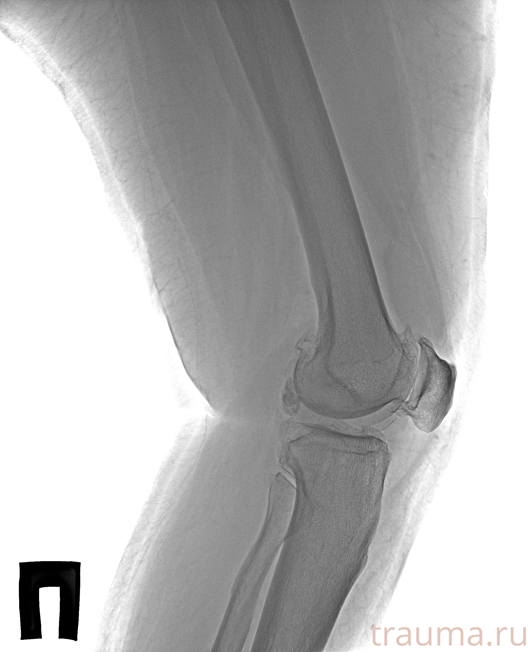 Рентген на дому: по вашему адресу приезжает врач-рентгенолог, травматолог-ортопед с мобильным рентгеновским аппаратом, проводит диагностику травмы или заболевания, делает необходимые рентгенограммы, дает рекомендации по дальнейшему лечению. Получить качественные снимки в домашних условиях возможно благодаря уникальной методике, разработанной МосРентген Центром для института  Склифосовского