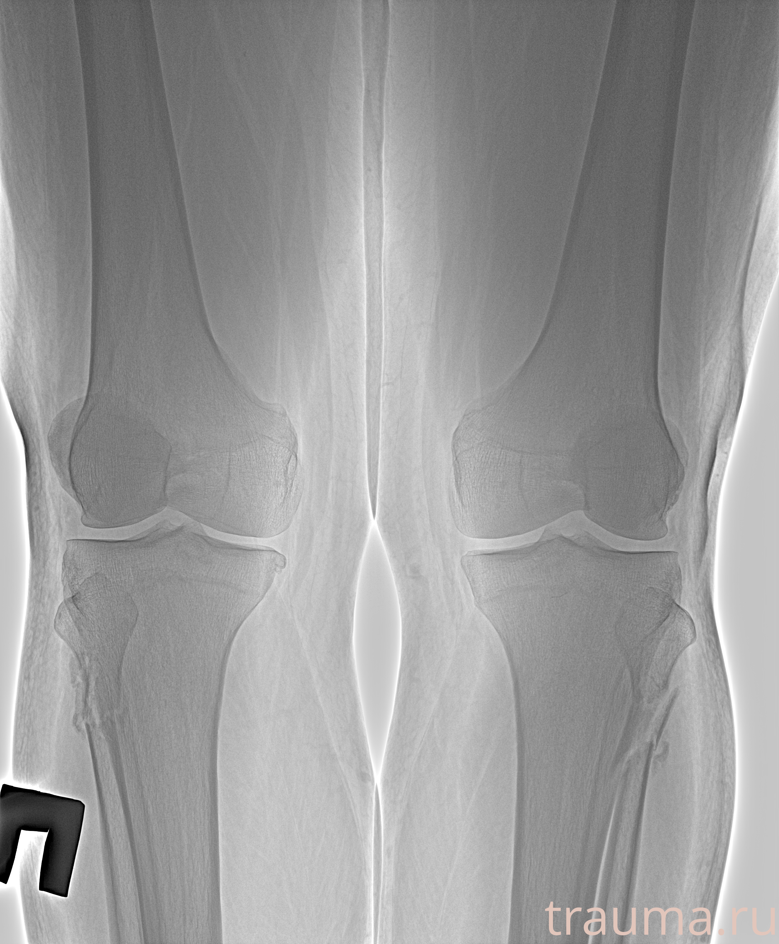 Рентген на дому: по вашему адресу приезжает врач-рентгенолог, травматолог-ортопед с мобильным рентгеновским аппаратом, проводит диагностику травмы или заболевания, делает необходимые рентгенограммы, дает рекомендации по дальнейшему лечению. Получить качественные снимки в домашних условиях возможно благодаря уникальной методике, разработанной МосРентген Центром для института  Склифосовского