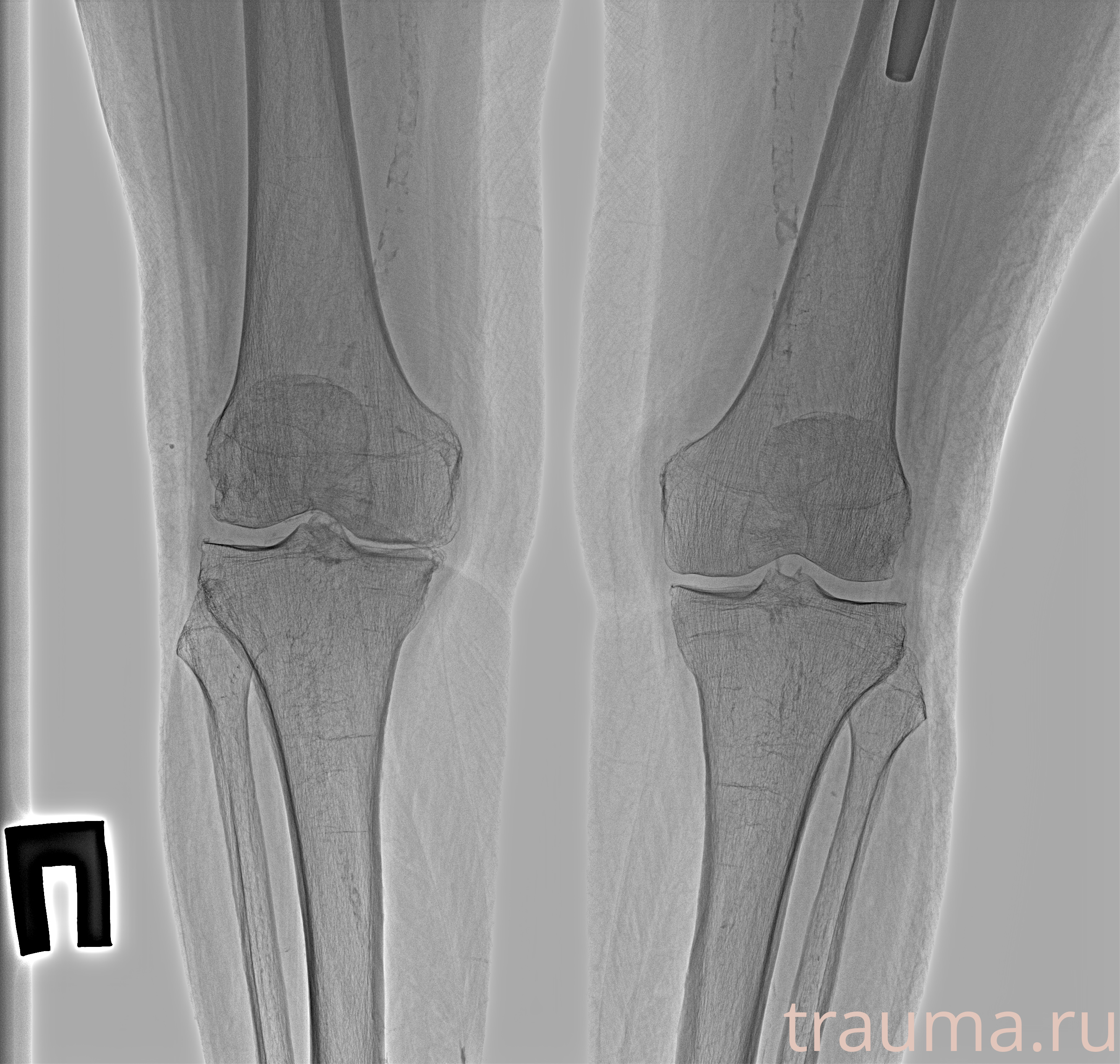 Рентген на дому: по вашему адресу приезжает врач-рентгенолог, травматолог-ортопед с мобильным рентгеновским аппаратом, проводит диагностику травмы или заболевания, делает необходимые рентгенограммы, дает рекомендации по дальнейшему лечению. Получить качественные снимки в домашних условиях возможно благодаря уникальной методике, разработанной МосРентген Центром для института  Склифосовского