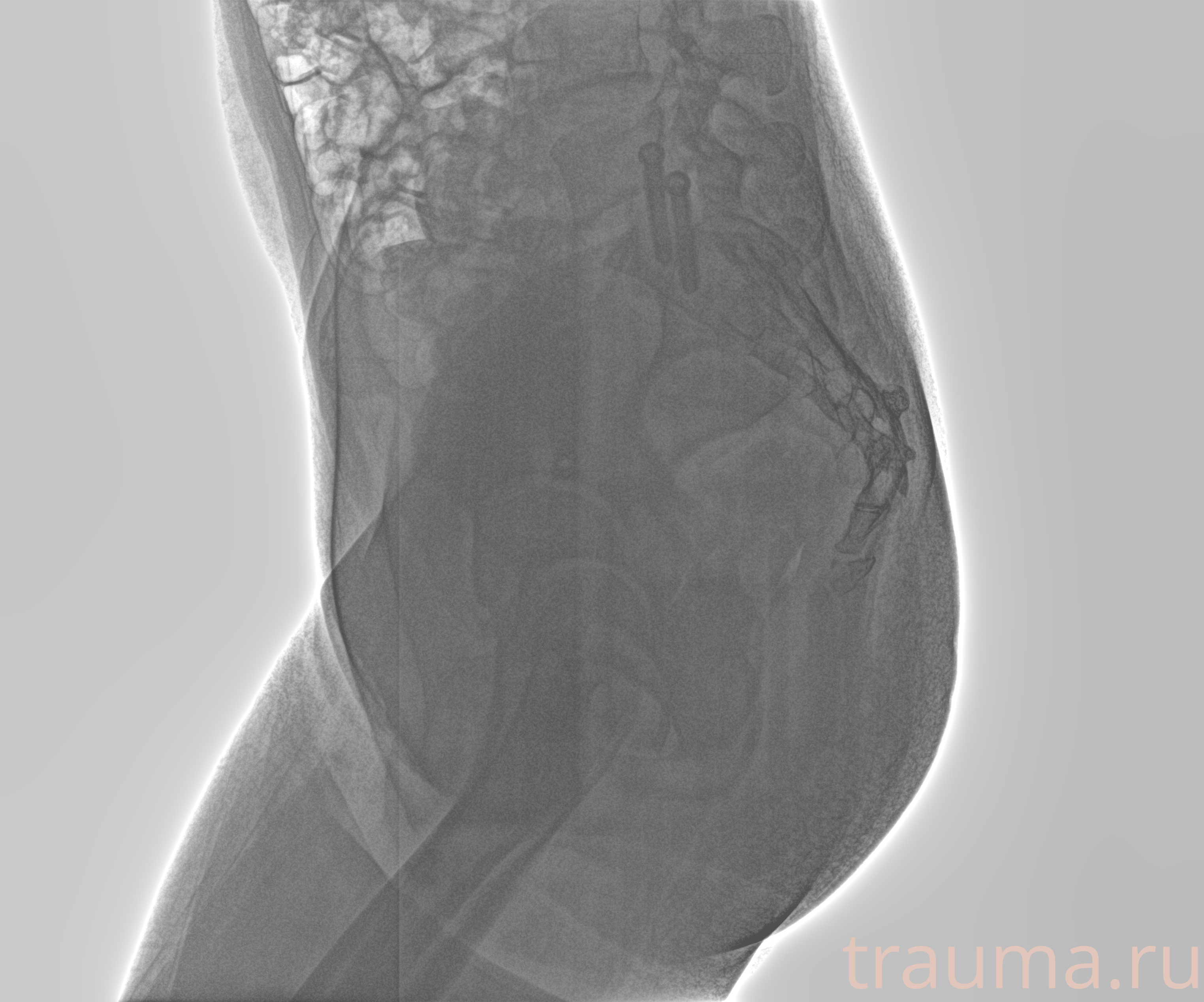 Рентген на дому: по вашему адресу приезжает врач-рентгенолог, травматолог-ортопед с мобильным рентгеновским аппаратом, проводит диагностику травмы или заболевания, делает необходимые рентгенограммы, дает рекомендации по дальнейшему лечению. Получить качественные снимки в домашних условиях возможно благодаря уникальной методике, разработанной МосРентген Центром для института  Склифосовского