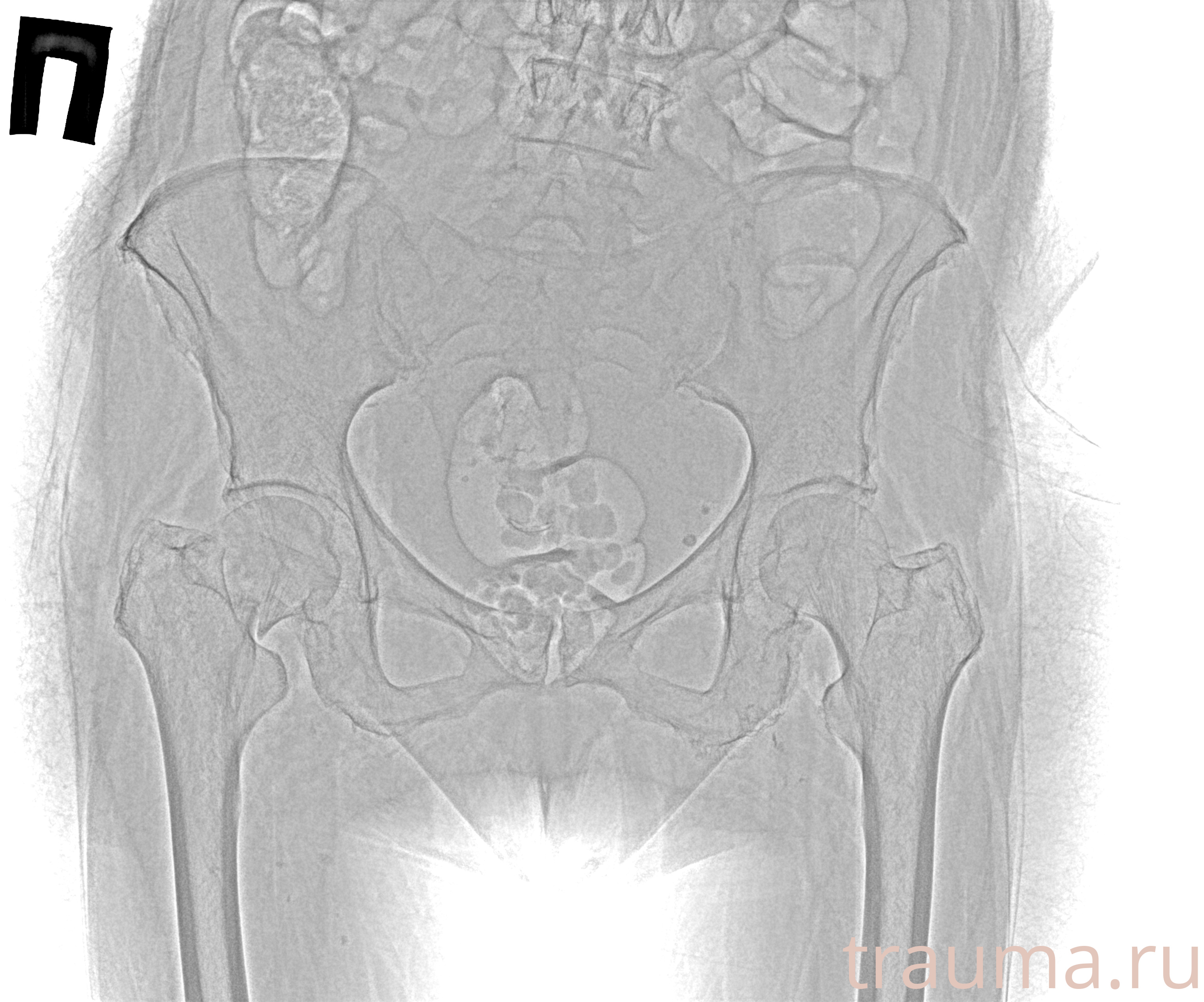 Рентген на дому: по вашему адресу приезжает врач-рентгенолог, травматолог-ортопед с мобильным рентгеновским аппаратом, проводит диагностику травмы или заболевания, делает необходимые рентгенограммы, дает рекомендации по дальнейшему лечению. Получить качественные снимки в домашних условиях возможно благодаря уникальной методике, разработанной МосРентген Центром для института  Склифосовского