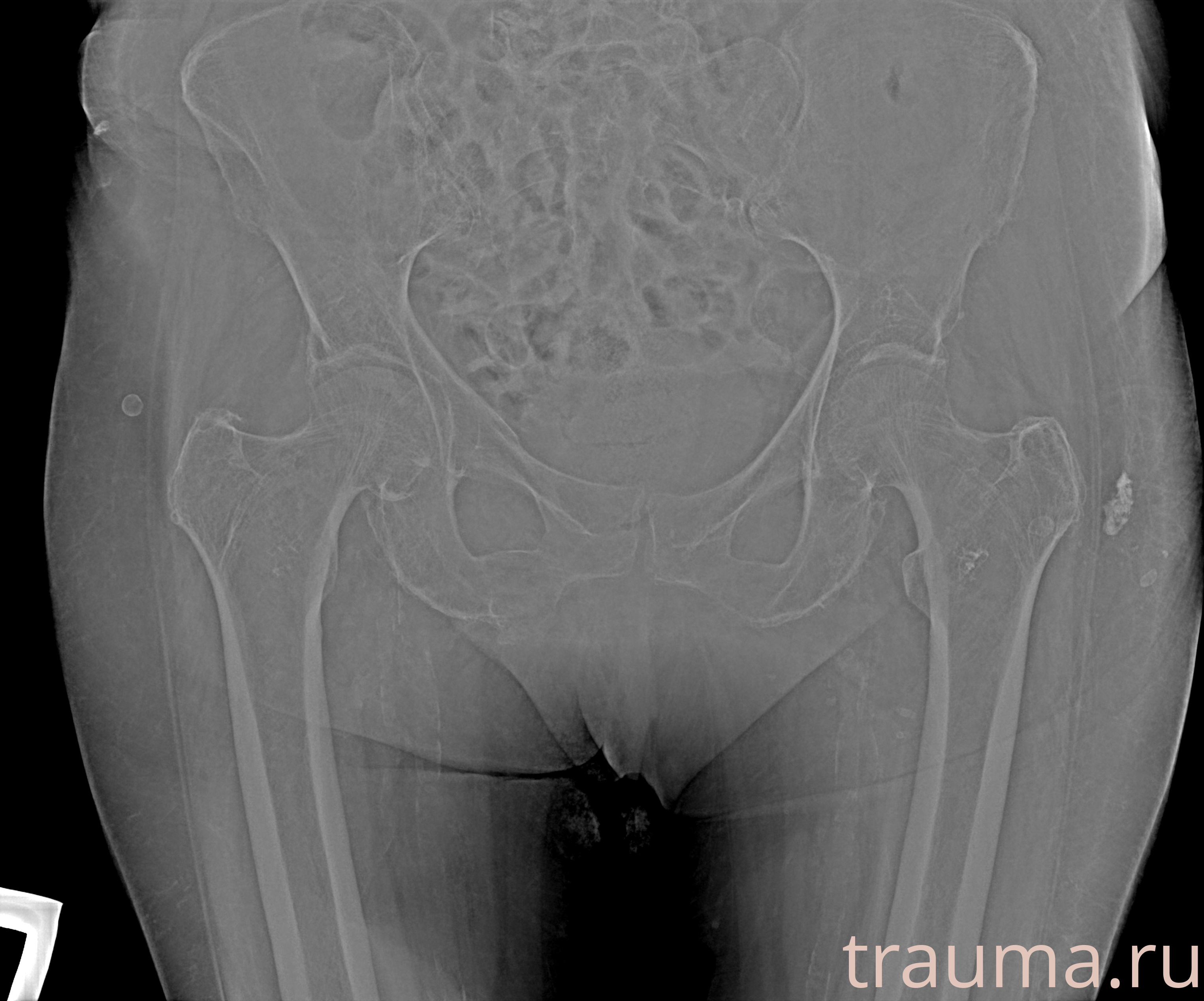 Рентген на дому: по вашему адресу приезжает врач-рентгенолог, травматолог-ортопед с мобильным рентгеновским аппаратом, проводит диагностику травмы или заболевания, делает необходимые рентгенограммы, дает рекомендации по дальнейшему лечению. Получить качественные снимки в домашних условиях возможно благодаря уникальной методике, разработанной МосРентген Центром для института  Склифосовского