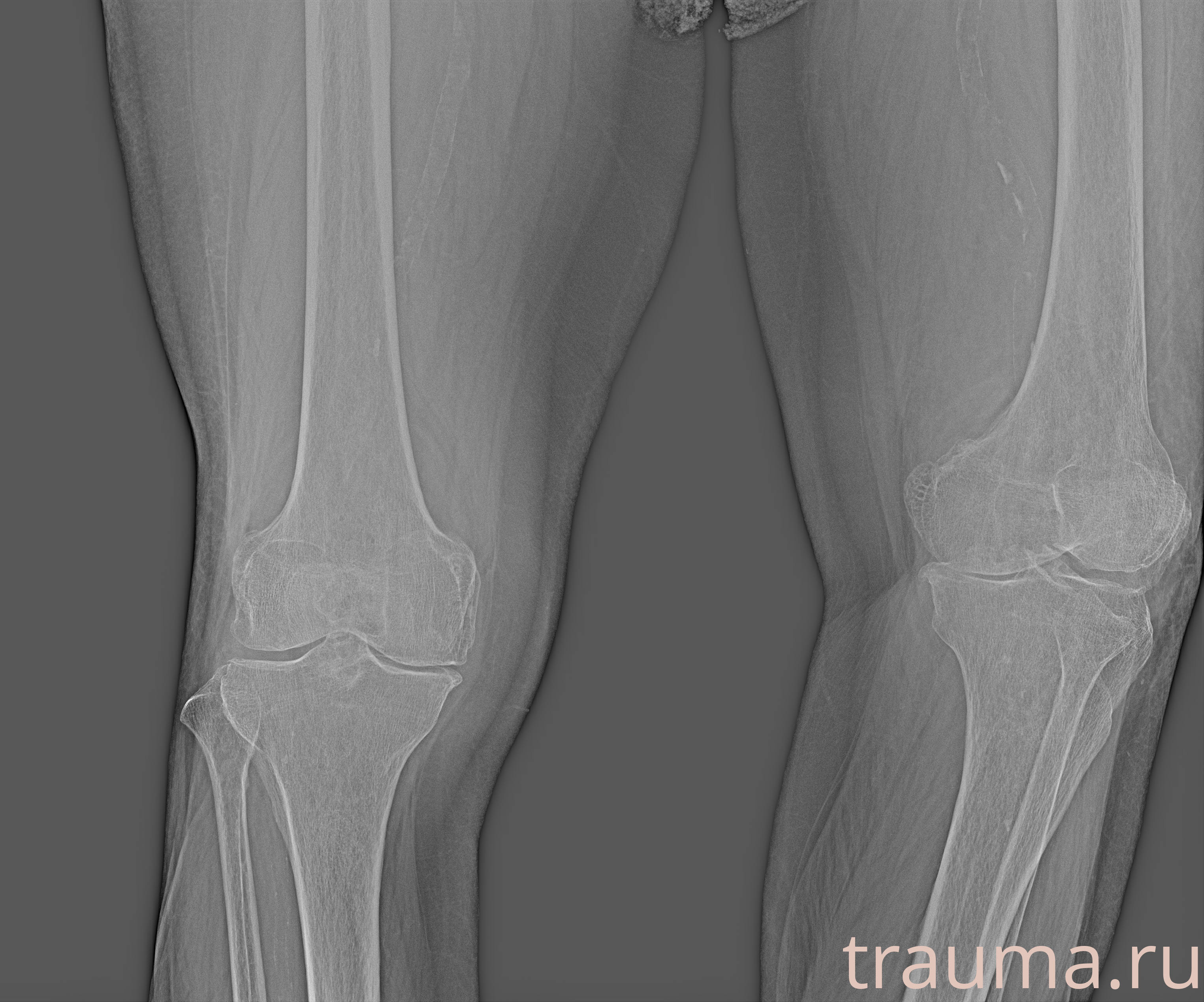 Рентген на дому: по вашему адресу приезжает врач-рентгенолог, травматолог-ортопед с мобильным рентгеновским аппаратом, проводит диагностику травмы или заболевания, делает необходимые рентгенограммы, дает рекомендации по дальнейшему лечению. Получить качественные снимки в домашних условиях возможно благодаря уникальной методике, разработанной МосРентген Центром для института  Склифосовского
