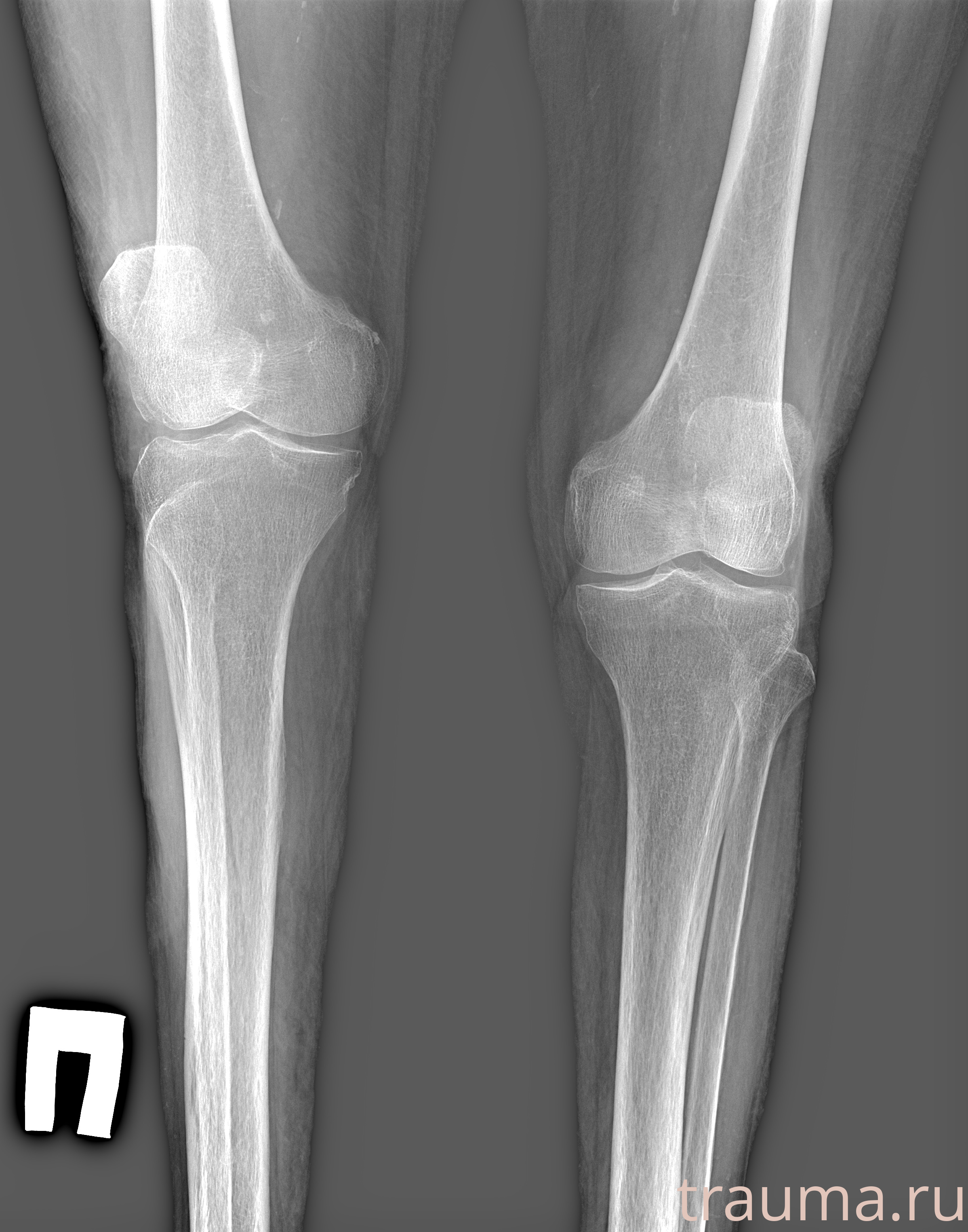 Рентген на дому: по вашему адресу приезжает врач-рентгенолог, травматолог-ортопед с мобильным рентгеновским аппаратом, проводит диагностику травмы или заболевания, делает необходимые рентгенограммы, дает рекомендации по дальнейшему лечению. Получить качественные снимки в домашних условиях возможно благодаря уникальной методике, разработанной МосРентген Центром для института  Склифосовского