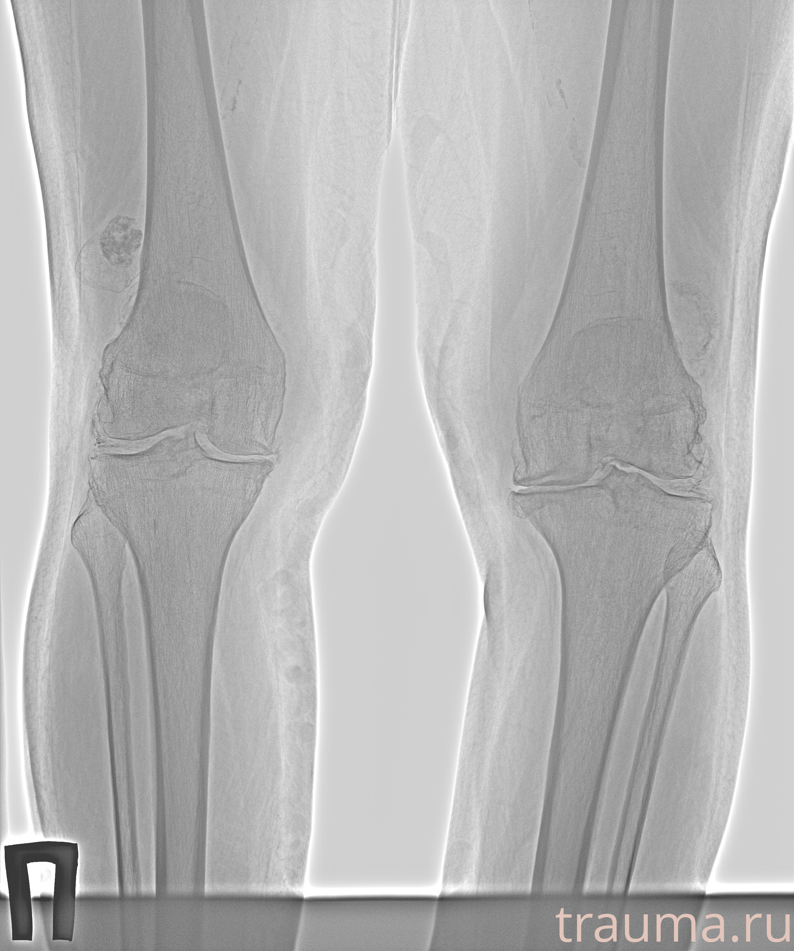 Рентген на дому: по вашему адресу приезжает врач-рентгенолог, травматолог-ортопед с мобильным рентгеновским аппаратом, проводит диагностику травмы или заболевания, делает необходимые рентгенограммы, дает рекомендации по дальнейшему лечению. Получить качественные снимки в домашних условиях возможно благодаря уникальной методике, разработанной МосРентген Центром для института  Склифосовского