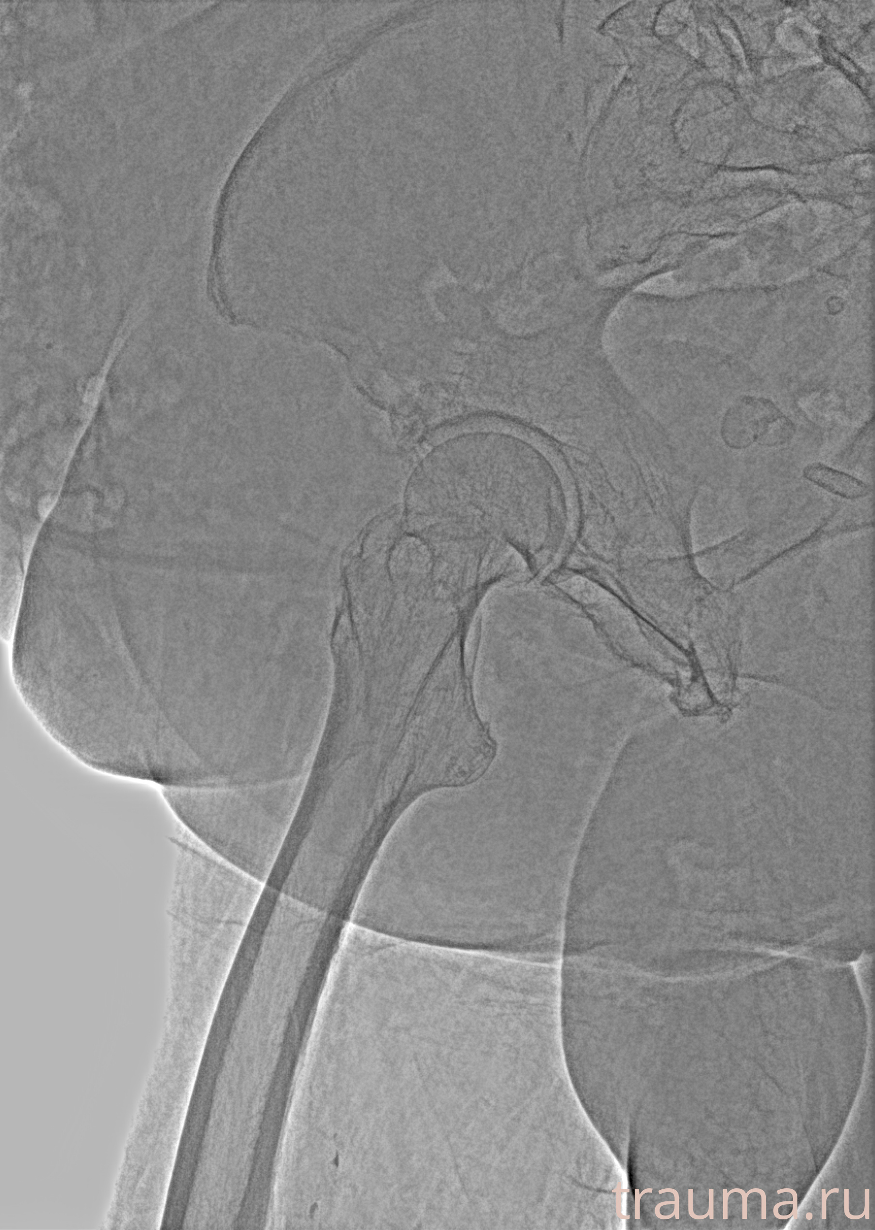 Рентген на дому: по вашему адресу приезжает врач-рентгенолог, травматолог-ортопед с мобильным рентгеновским аппаратом, проводит диагностику травмы или заболевания, делает необходимые рентгенограммы, дает рекомендации по дальнейшему лечению. Получить качественные снимки в домашних условиях возможно благодаря уникальной методике, разработанной МосРентген Центром для института  Склифосовского