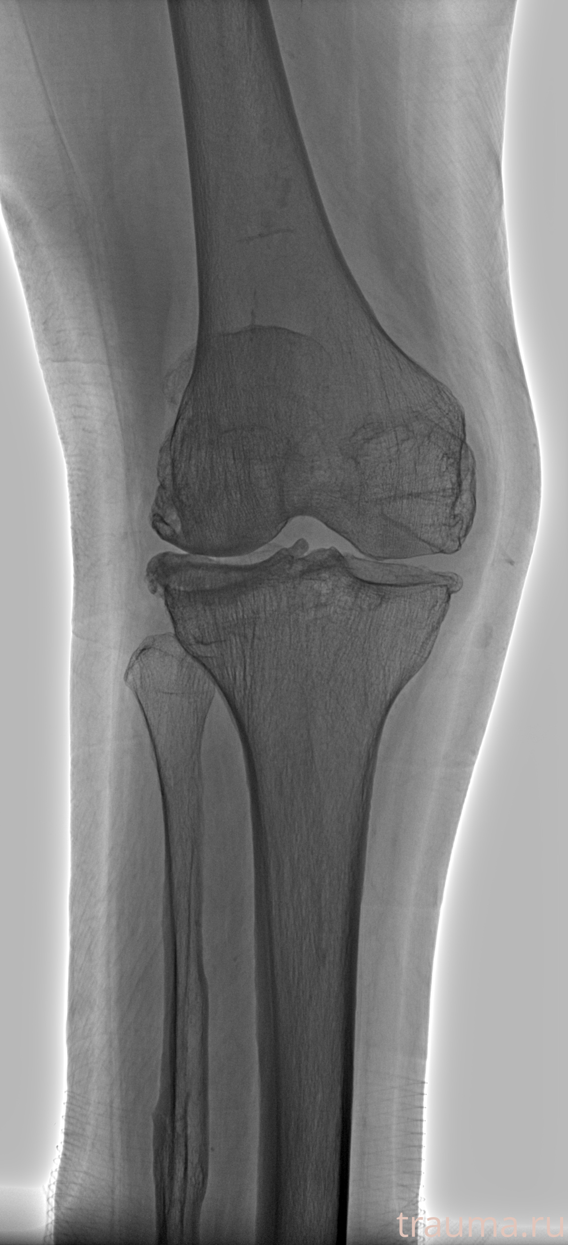 Рентген на дому: по вашему адресу приезжает врач-рентгенолог, травматолог-ортопед с мобильным рентгеновским аппаратом, проводит диагностику травмы или заболевания, делает необходимые рентгенограммы, дает рекомендации по дальнейшему лечению. Получить качественные снимки в домашних условиях возможно благодаря уникальной методике, разработанной МосРентген Центром для института  Склифосовского