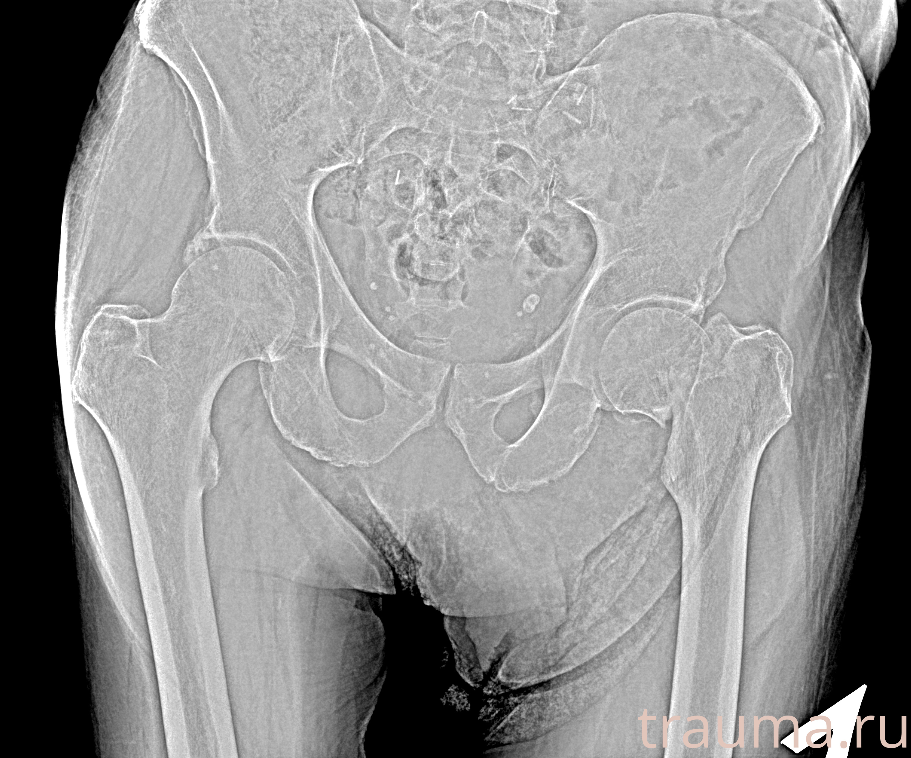 Рентген на дому: по вашему адресу приезжает врач-рентгенолог, травматолог-ортопед с мобильным рентгеновским аппаратом, проводит диагностику травмы или заболевания, делает необходимые рентгенограммы, дает рекомендации по дальнейшему лечению. Получить качественные снимки в домашних условиях возможно благодаря уникальной методике, разработанной МосРентген Центром для института  Склифосовского