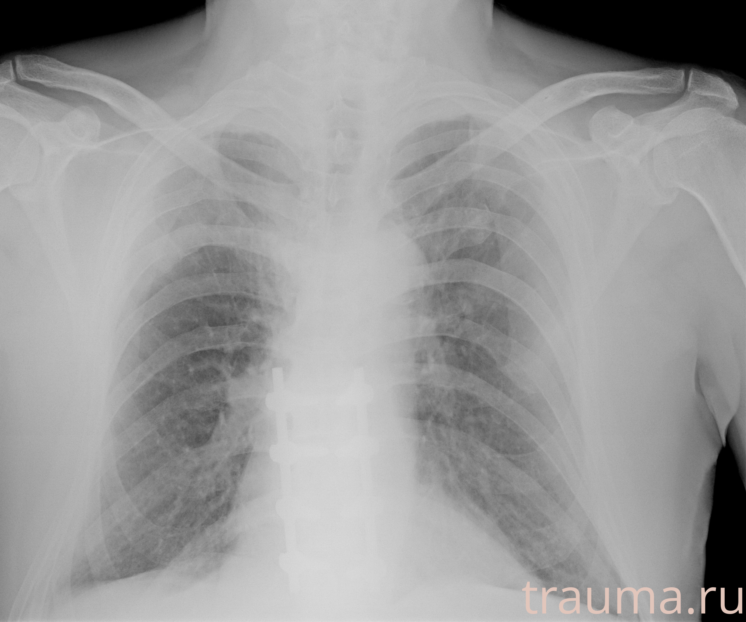 Рентген на дому: по вашему адресу приезжает врач-рентгенолог, травматолог-ортопед с мобильным рентгеновским аппаратом, проводит диагностику травмы или заболевания, делает необходимые рентгенограммы, дает рекомендации по дальнейшему лечению. Получить качественные снимки в домашних условиях возможно благодаря уникальной методике, разработанной МосРентген Центром для института  Склифосовского