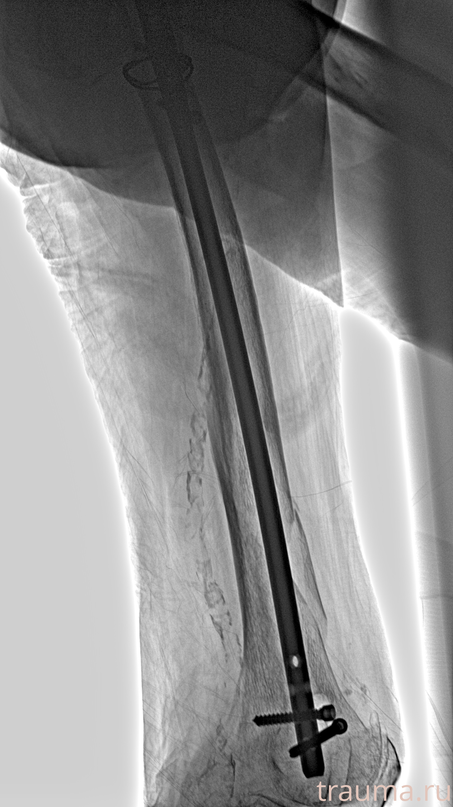 Рентген на дому: по вашему адресу приезжает врач-рентгенолог, травматолог-ортопед с мобильным рентгеновским аппаратом, проводит диагностику травмы или заболевания, делает необходимые рентгенограммы, дает рекомендации по дальнейшему лечению. Получить качественные снимки в домашних условиях возможно благодаря уникальной методике, разработанной МосРентген Центром для института  Склифосовского