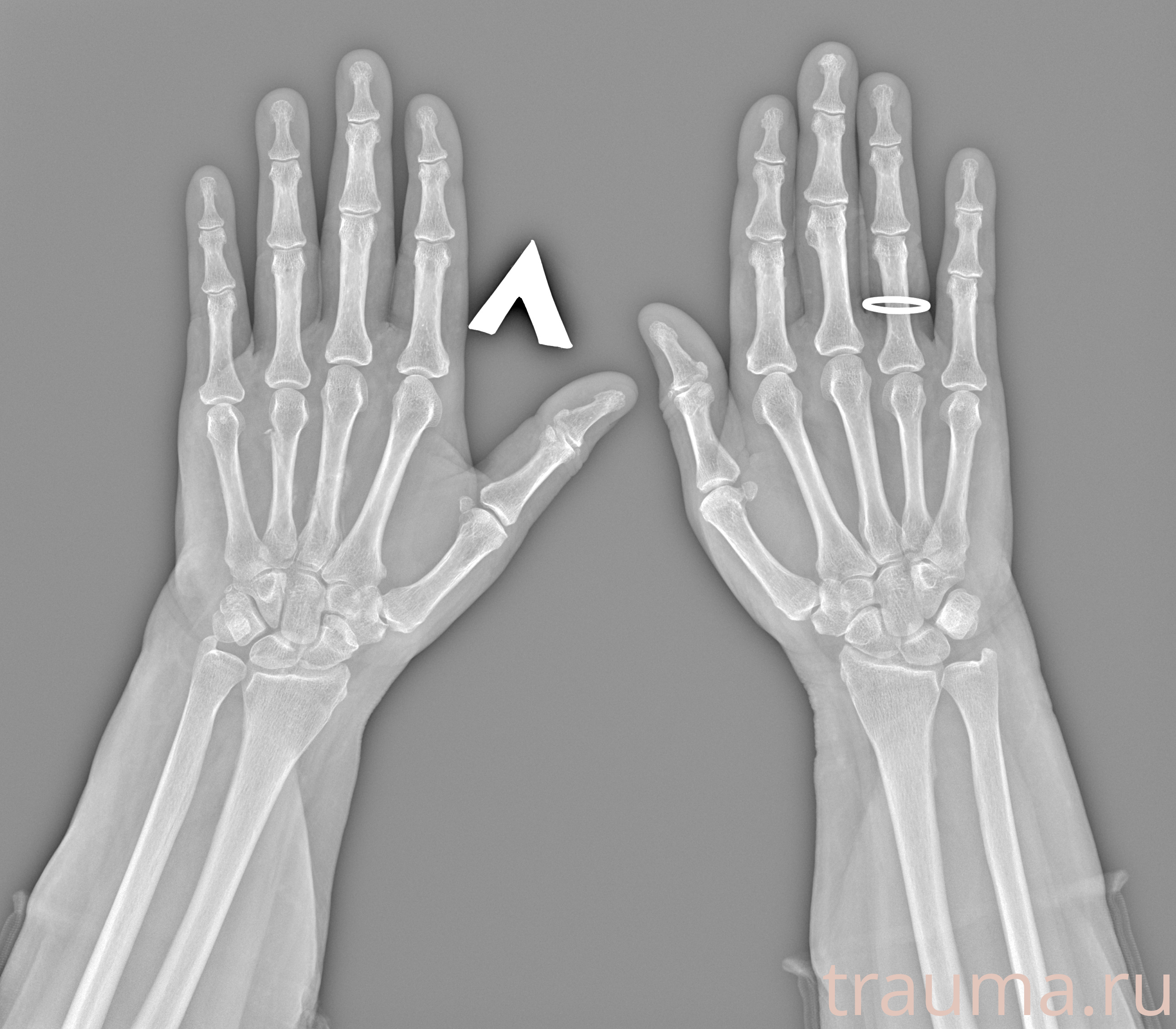 Рентген на дому: по вашему адресу приезжает врач-рентгенолог, травматолог-ортопед с мобильным рентгеновским аппаратом, проводит диагностику травмы или заболевания, делает необходимые рентгенограммы, дает рекомендации по дальнейшему лечению. Получить качественные снимки в домашних условиях возможно благодаря уникальной методике, разработанной МосРентген Центром для института  Склифосовского