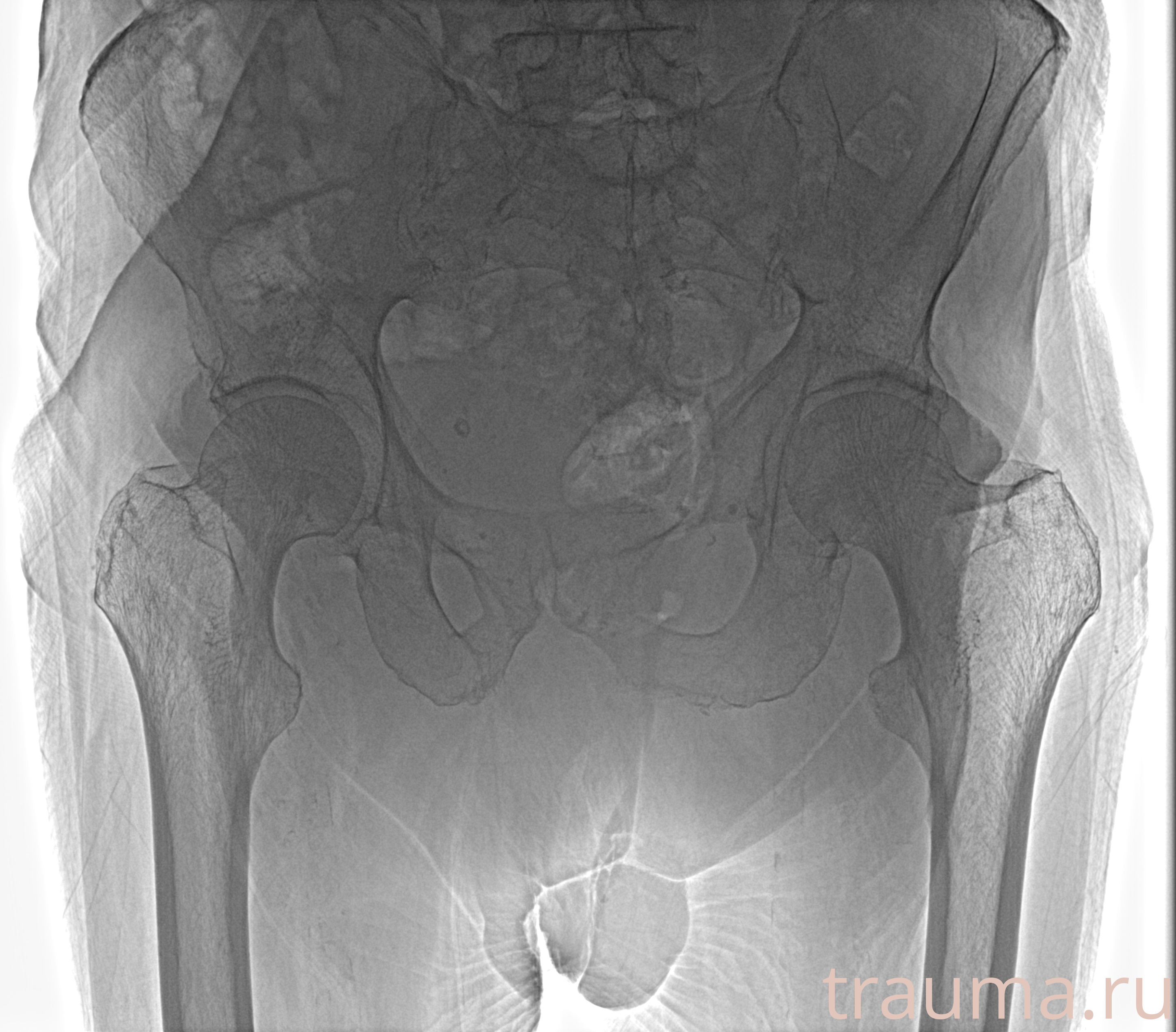 Рентген на дому: по вашему адресу приезжает врач-рентгенолог, травматолог-ортопед с мобильным рентгеновским аппаратом, проводит диагностику травмы или заболевания, делает необходимые рентгенограммы, дает рекомендации по дальнейшему лечению. Получить качественные снимки в домашних условиях возможно благодаря уникальной методике, разработанной МосРентген Центром для института  Склифосовского