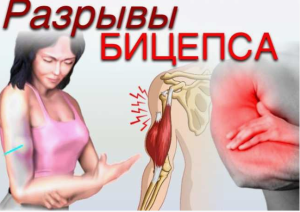 Оказание специализированной помощи пациентам с разрывом дистального сухожилия двуглавой мышцы плеча: диагностика и алгоритм лечения