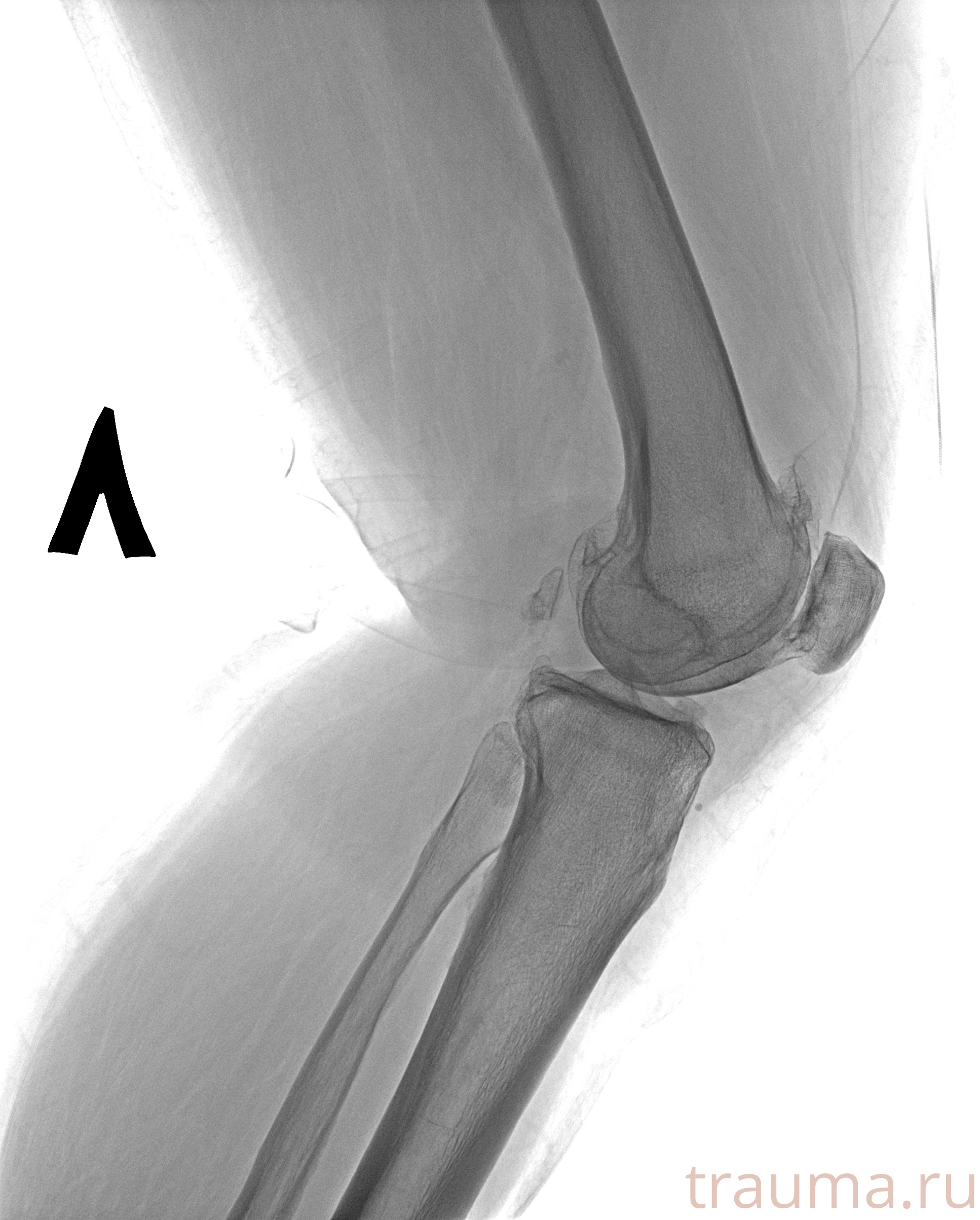 Рентген на дому: по вашему адресу приезжает врач-рентгенолог, травматолог-ортопед с мобильным рентгеновским аппаратом, проводит диагностику травмы или заболевания, делает необходимые рентгенограммы, дает рекомендации по дальнейшему лечению. Получить качественные снимки в домашних условиях возможно благодаря уникальной методике, разработанной МосРентген Центром для института  Склифосовского