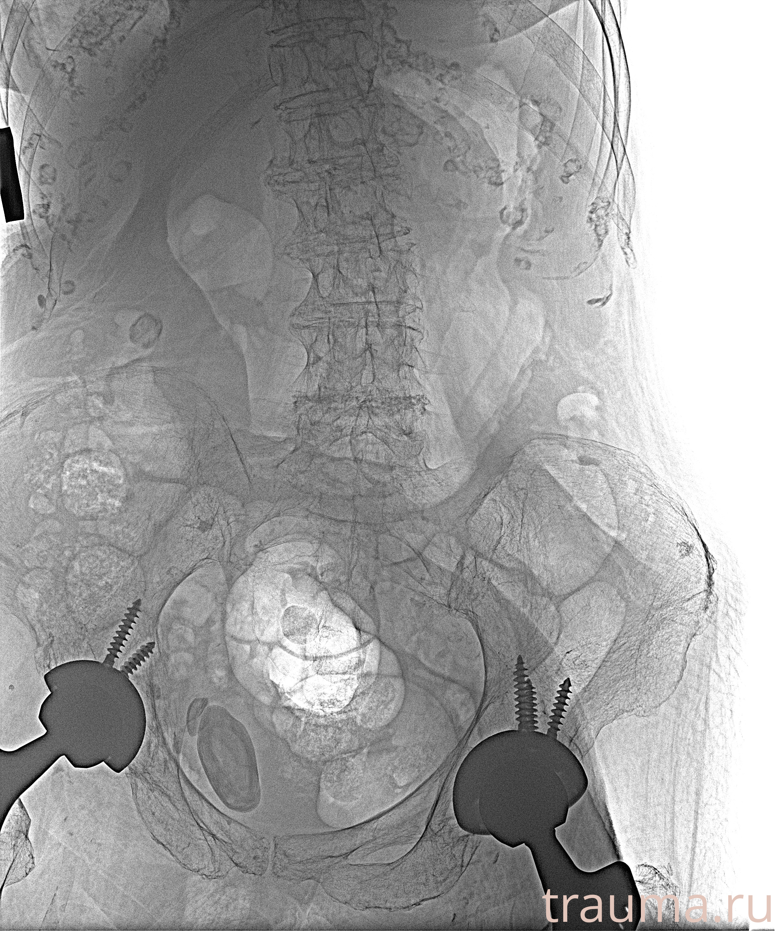 Рентген на дому: по вашему адресу приезжает врач-рентгенолог, травматолог-ортопед с мобильным рентгеновским аппаратом, проводит диагностику травмы или заболевания, делает необходимые рентгенограммы, дает рекомендации по дальнейшему лечению. Получить качественные снимки в домашних условиях возможно благодаря уникальной методике, разработанной МосРентген Центром для института  Склифосовского