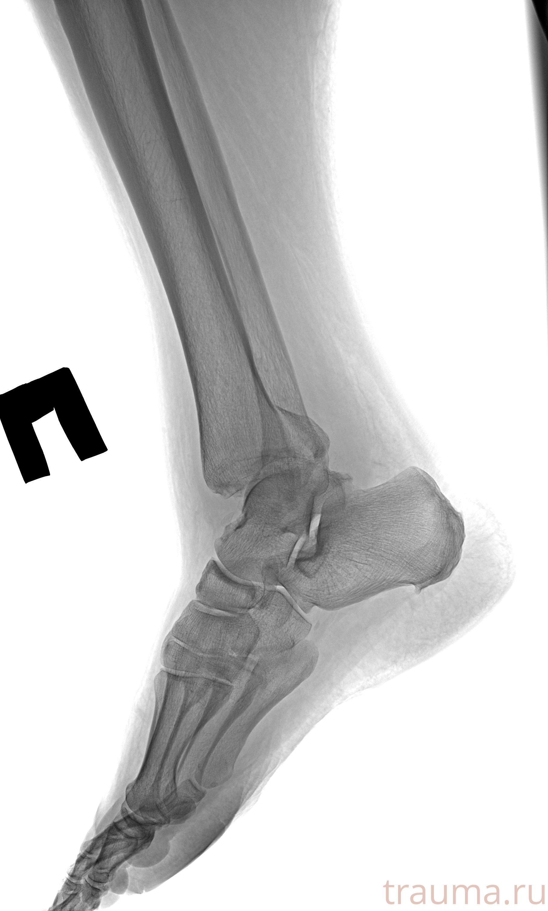 Рентген на дому: по вашему адресу приезжает врач-рентгенолог, травматолог-ортопед с мобильным рентгеновским аппаратом, проводит диагностику травмы или заболевания, делает необходимые рентгенограммы, дает рекомендации по дальнейшему лечению. Получить качественные снимки в домашних условиях возможно благодаря уникальной методике, разработанной МосРентген Центром для института  Склифосовского