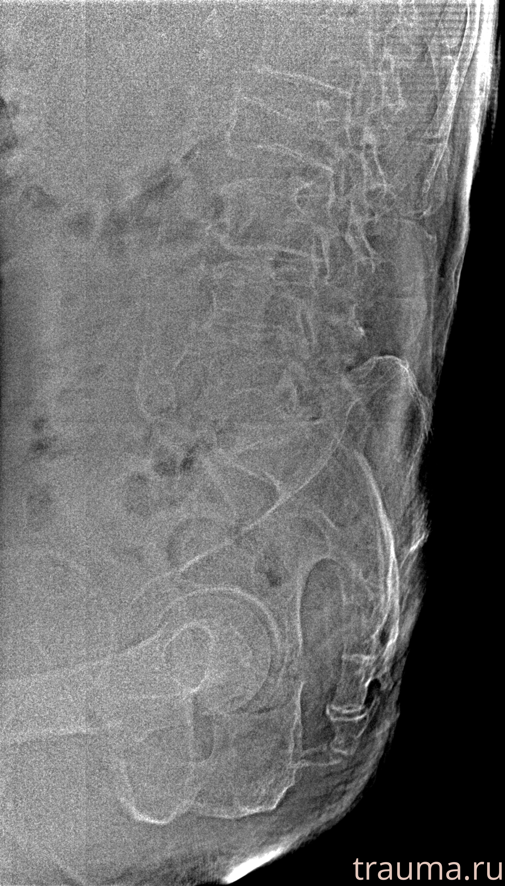 Рентген на дому: по вашему адресу приезжает врач-рентгенолог, травматолог-ортопед с мобильным рентгеновским аппаратом, проводит диагностику травмы или заболевания, делает необходимые рентгенограммы, дает рекомендации по дальнейшему лечению. Получить качественные снимки в домашних условиях возможно благодаря уникальной методике, разработанной МосРентген Центром для института  Склифосовского