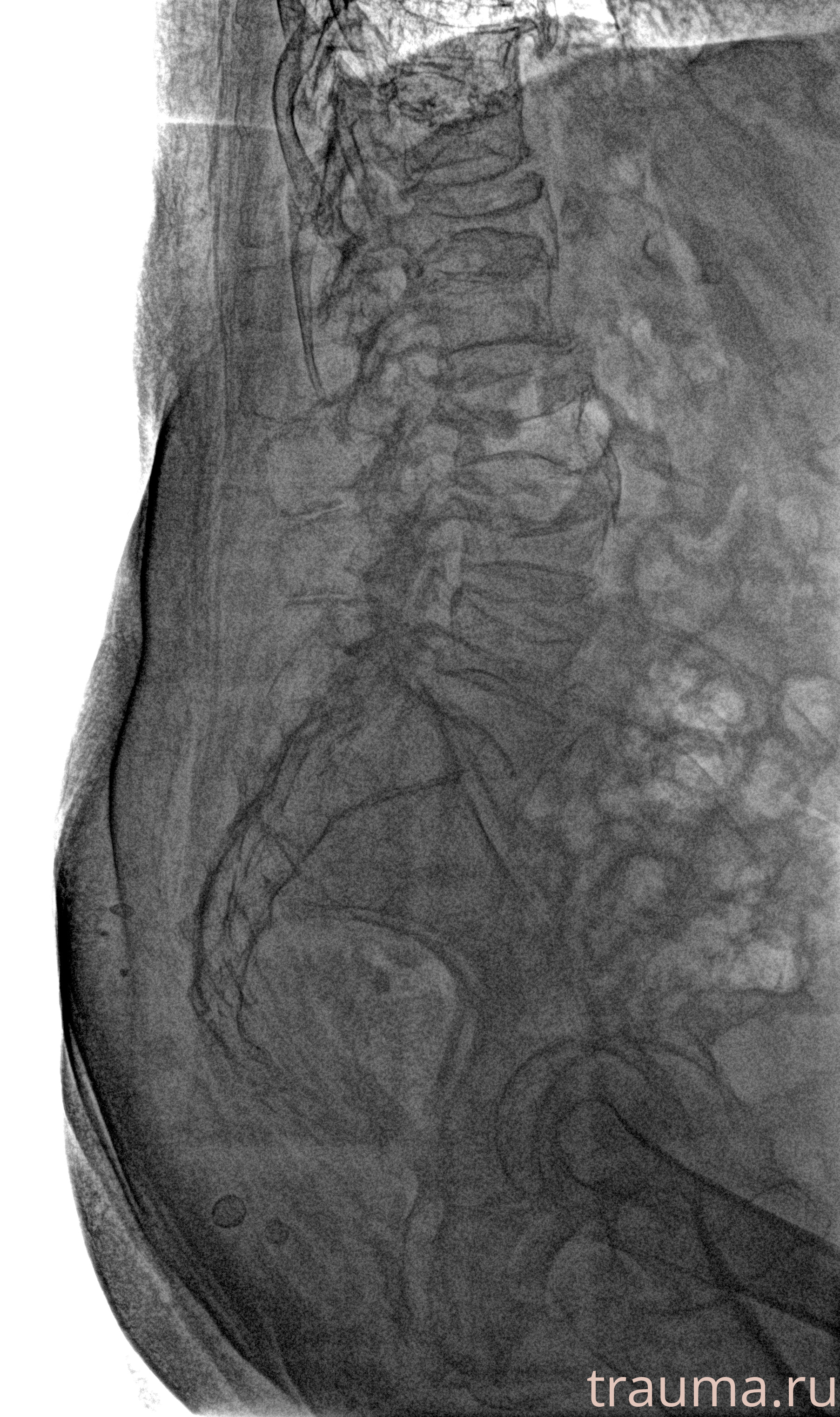Рентген на дому: по вашему адресу приезжает врач-рентгенолог, травматолог-ортопед с мобильным рентгеновским аппаратом, проводит диагностику травмы или заболевания, делает необходимые рентгенограммы, дает рекомендации по дальнейшему лечению. Получить качественные снимки в домашних условиях возможно благодаря уникальной методике, разработанной МосРентген Центром для института  Склифосовского