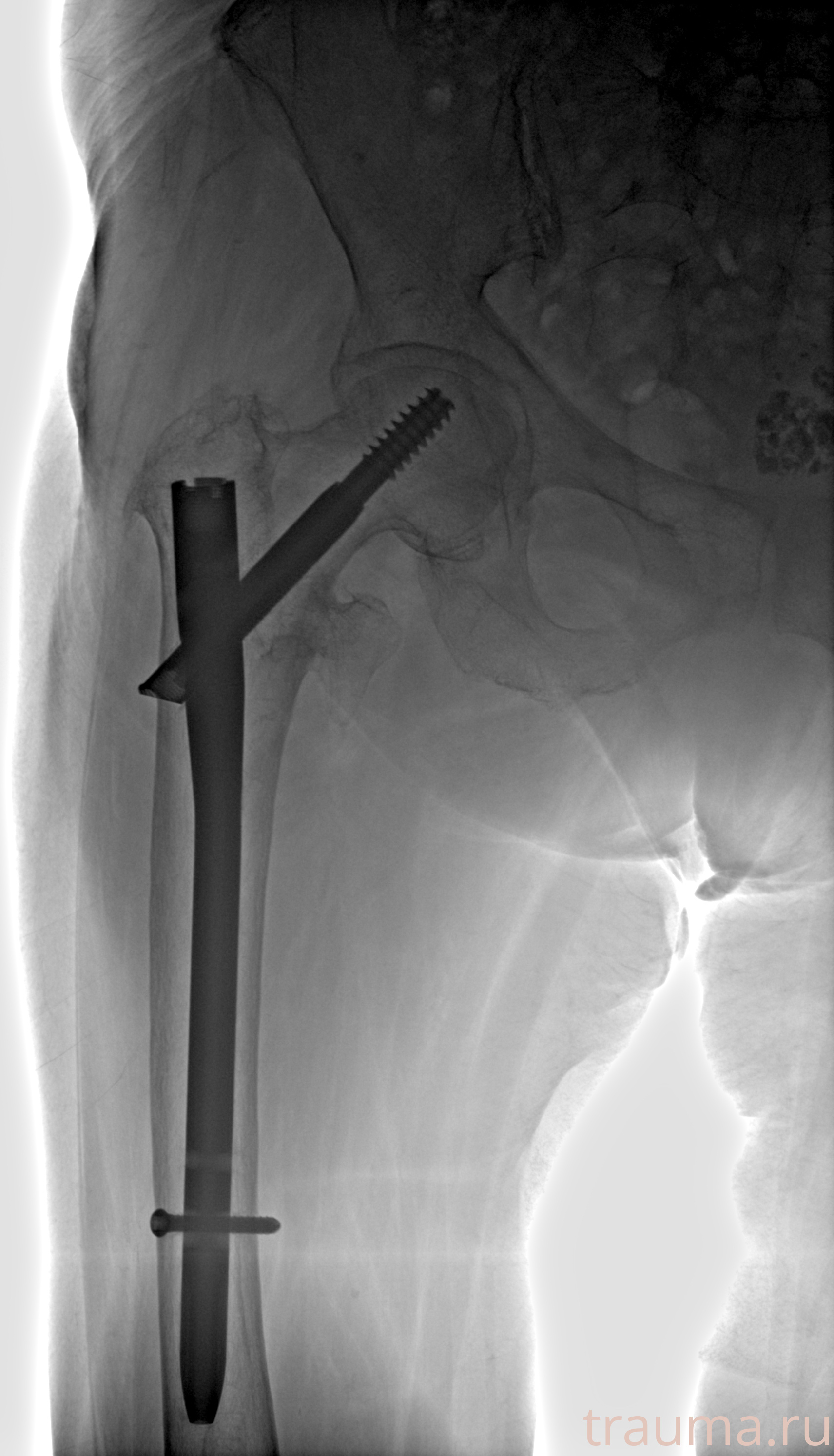 Рентген на дому: по вашему адресу приезжает врач-рентгенолог, травматолог-ортопед с мобильным рентгеновским аппаратом, проводит диагностику травмы или заболевания, делает необходимые рентгенограммы, дает рекомендации по дальнейшему лечению. Получить качественные снимки в домашних условиях возможно благодаря уникальной методике, разработанной МосРентген Центром для института  Склифосовского