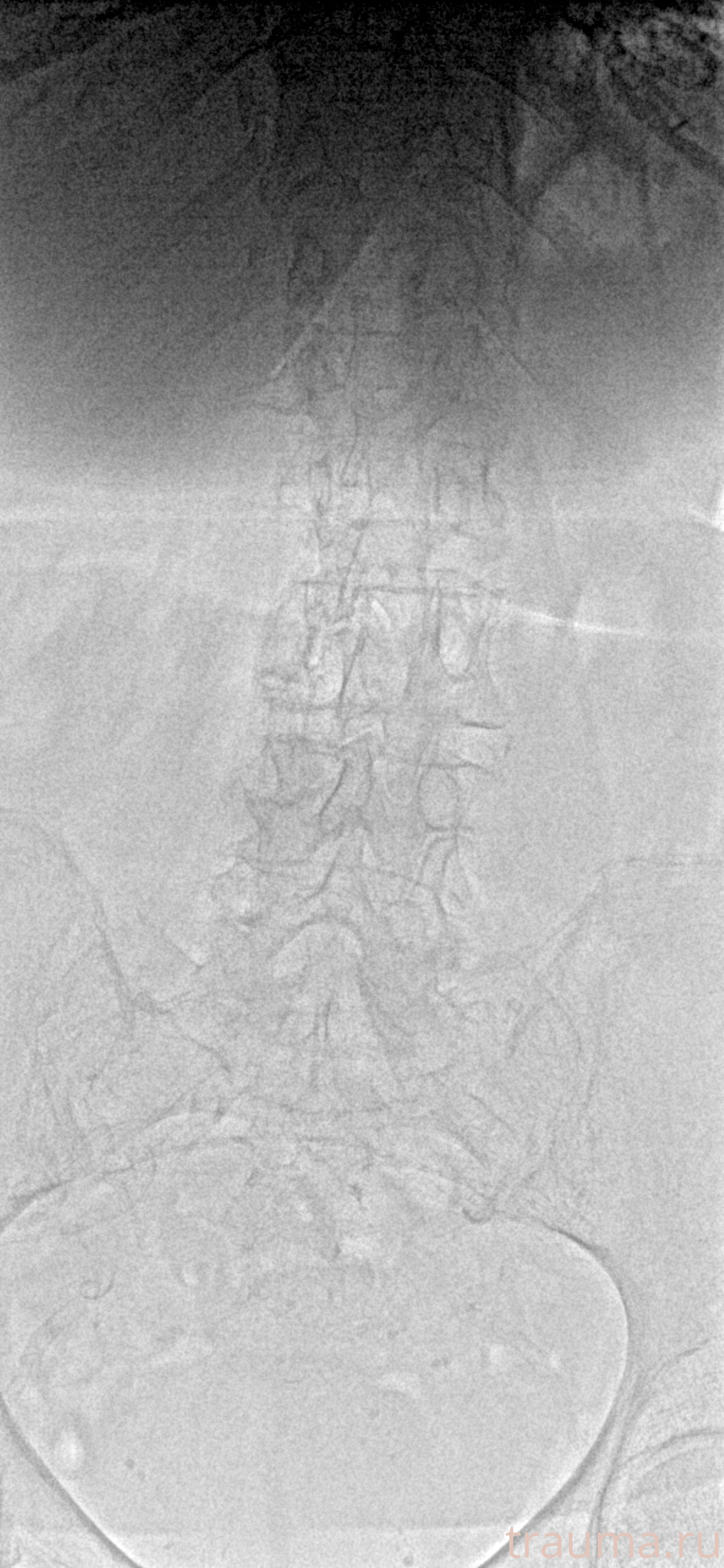 Рентген на дому: по вашему адресу приезжает врач-рентгенолог, травматолог-ортопед с мобильным рентгеновским аппаратом, проводит диагностику травмы или заболевания, делает необходимые рентгенограммы, дает рекомендации по дальнейшему лечению. Получить качественные снимки в домашних условиях возможно благодаря уникальной методике, разработанной МосРентген Центром для института  Склифосовского