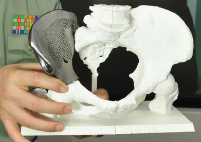 В МАИ разрабатывают адаптивные 3D-печатные вкладыши для протезов и ортезов В МАИ разрабатывают адаптивные 3D-печатные вкладыши для протезов и ортезов