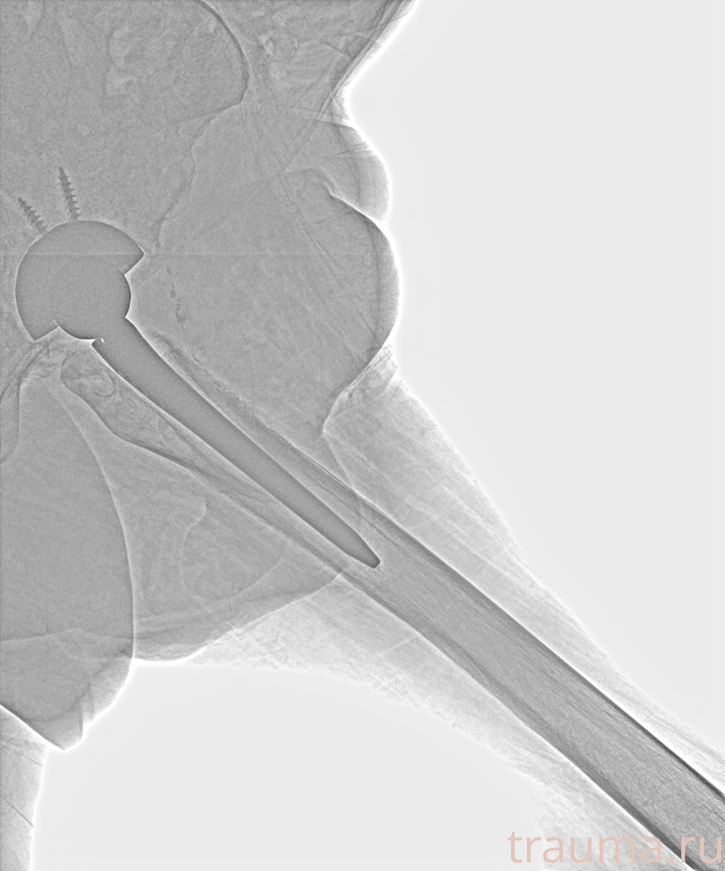 Рентген на дому: по вашему адресу приезжает врач-рентгенолог, травматолог-ортопед с мобильным рентгеновским аппаратом, проводит диагностику травмы или заболевания, делает необходимые рентгенограммы, дает рекомендации по дальнейшему лечению. Получить качественные снимки в домашних условиях возможно благодаря уникальной методике, разработанной МосРентген Центром для института  Склифосовского