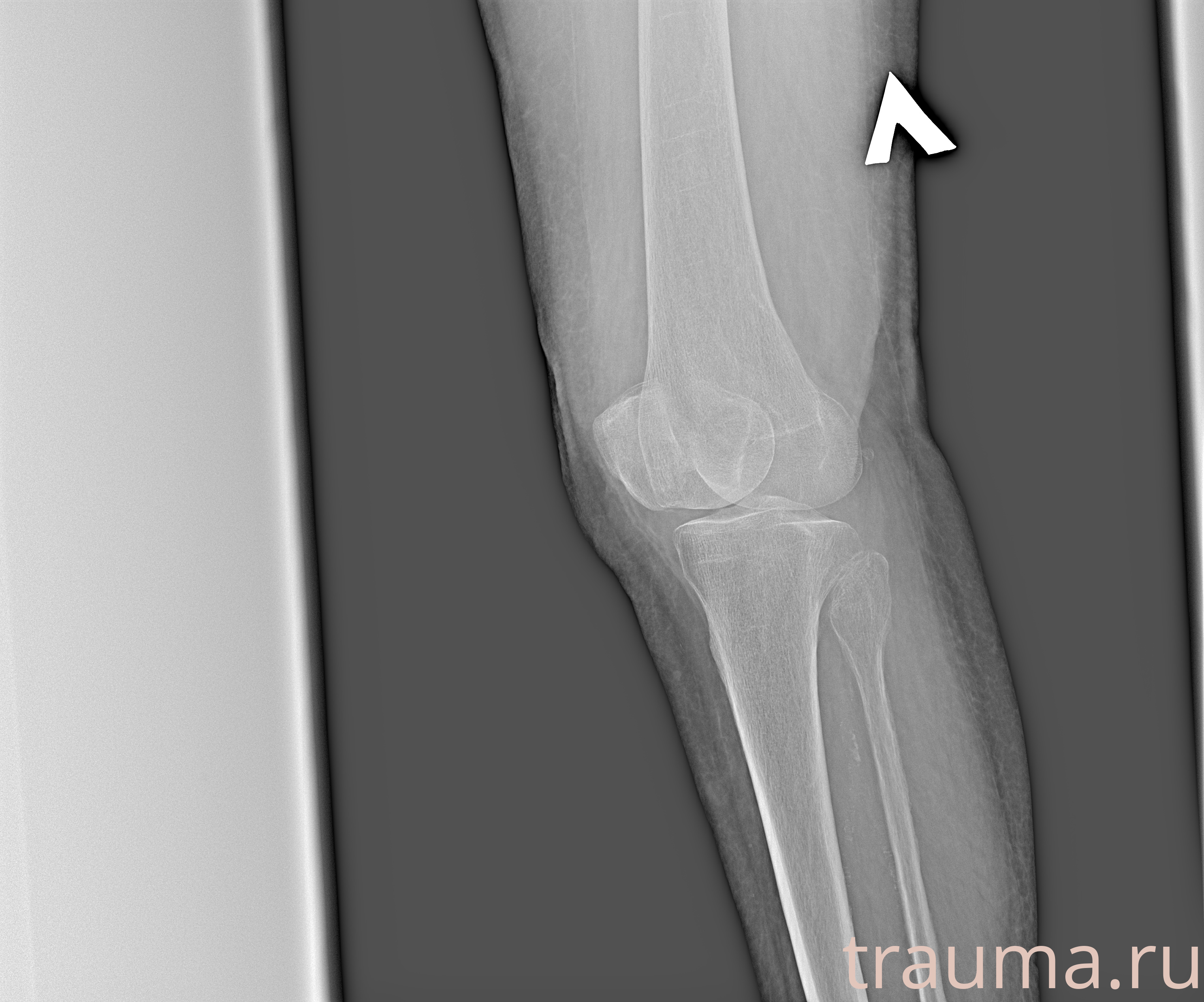 Рентген на дому: по вашему адресу приезжает врач-рентгенолог, травматолог-ортопед с мобильным рентгеновским аппаратом, проводит диагностику травмы или заболевания, делает необходимые рентгенограммы, дает рекомендации по дальнейшему лечению. Получить качественные снимки в домашних условиях возможно благодаря уникальной методике, разработанной МосРентген Центром для института  Склифосовского