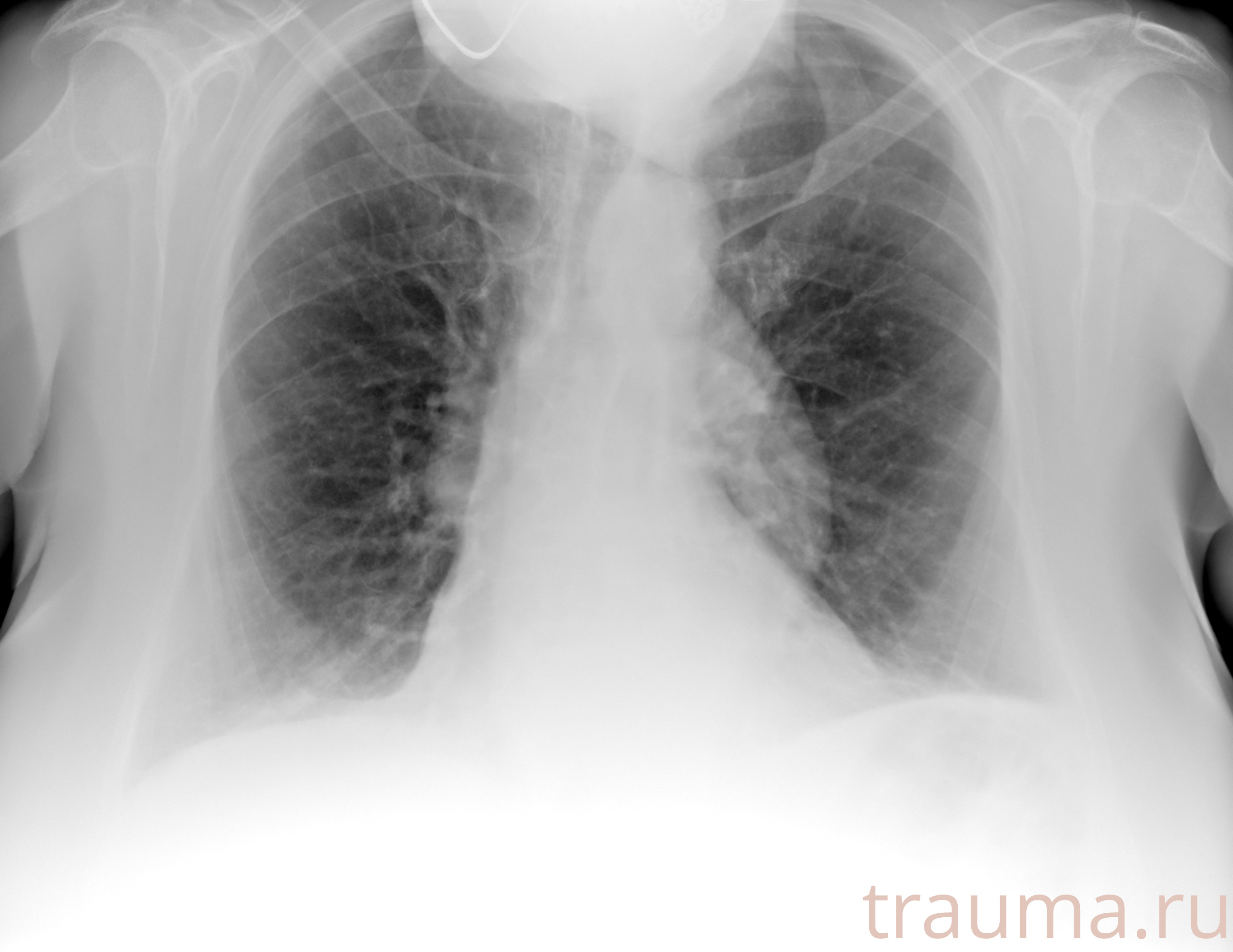 Рентген на дому: по вашему адресу приезжает врач-рентгенолог, травматолог-ортопед с мобильным рентгеновским аппаратом, проводит диагностику травмы или заболевания, делает необходимые рентгенограммы, дает рекомендации по дальнейшему лечению. Получить качественные снимки в домашних условиях возможно благодаря уникальной методике, разработанной МосРентген Центром для института  Склифосовского