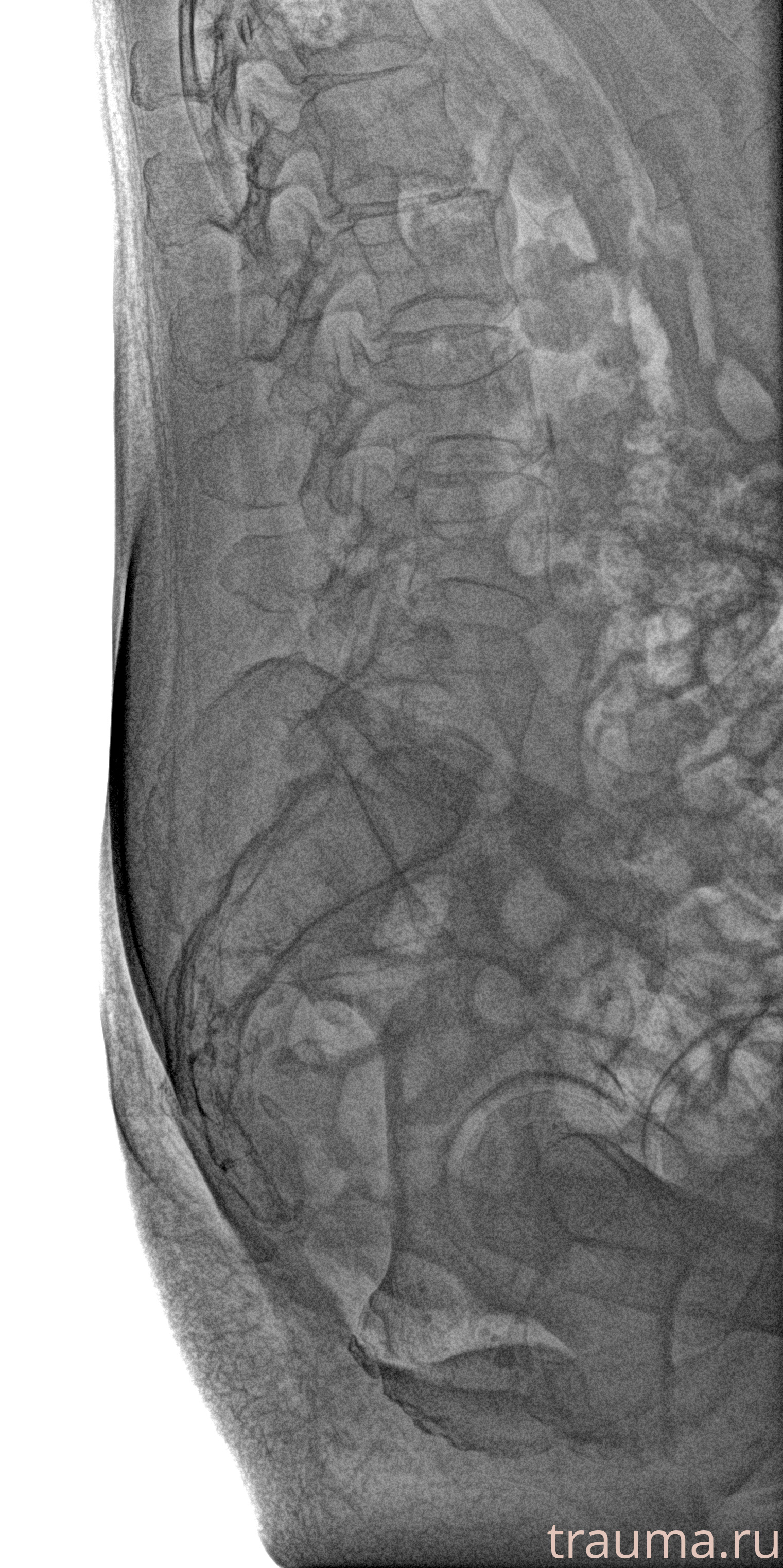 Рентген на дому: по вашему адресу приезжает врач-рентгенолог, травматолог-ортопед с мобильным рентгеновским аппаратом, проводит диагностику травмы или заболевания, делает необходимые рентгенограммы, дает рекомендации по дальнейшему лечению. Получить качественные снимки в домашних условиях возможно благодаря уникальной методике, разработанной МосРентген Центром для института  Склифосовского