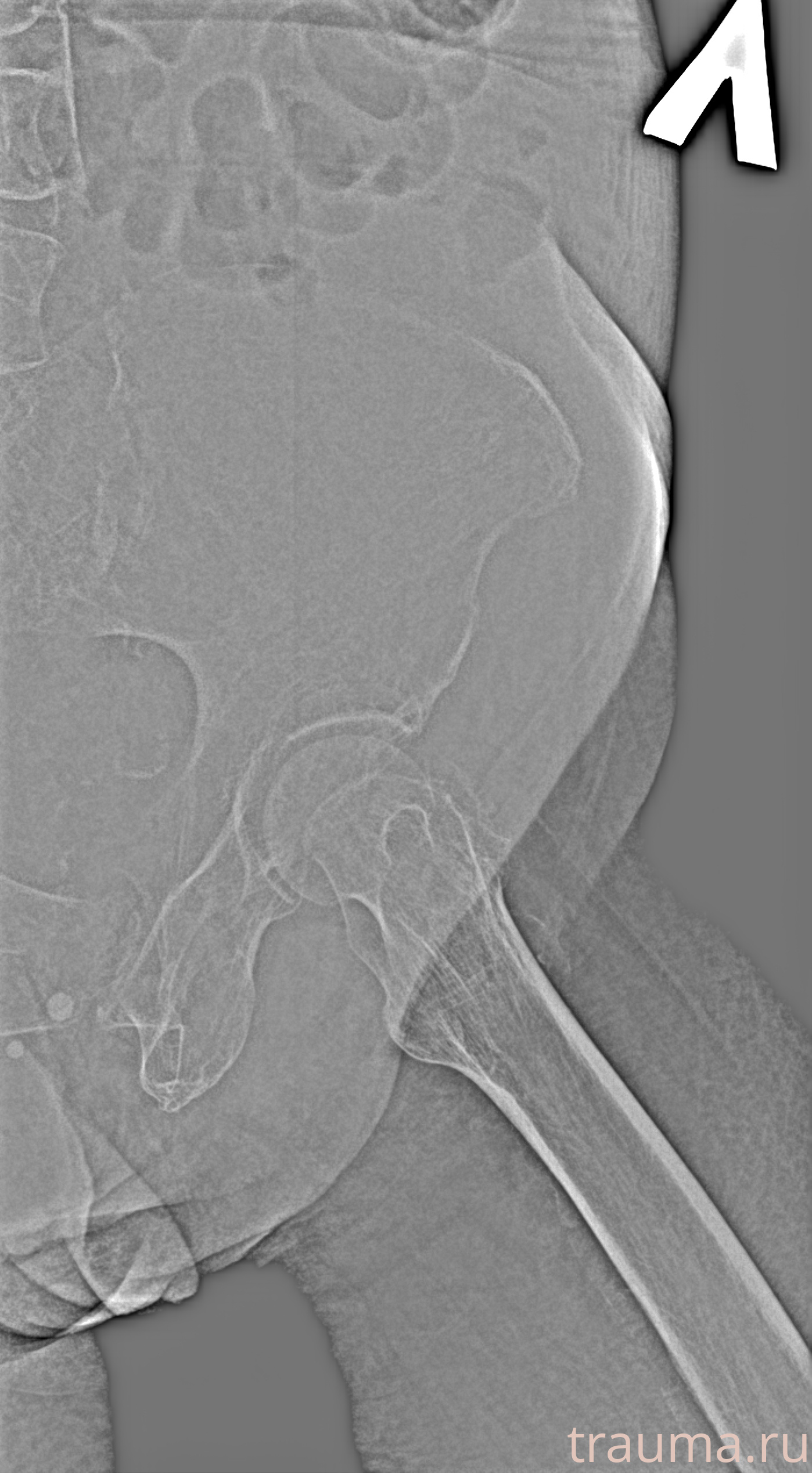 Рентген на дому: по вашему адресу приезжает врач-рентгенолог, травматолог-ортопед с мобильным рентгеновским аппаратом, проводит диагностику травмы или заболевания, делает необходимые рентгенограммы, дает рекомендации по дальнейшему лечению. Получить качественные снимки в домашних условиях возможно благодаря уникальной методике, разработанной МосРентген Центром для института  Склифосовского