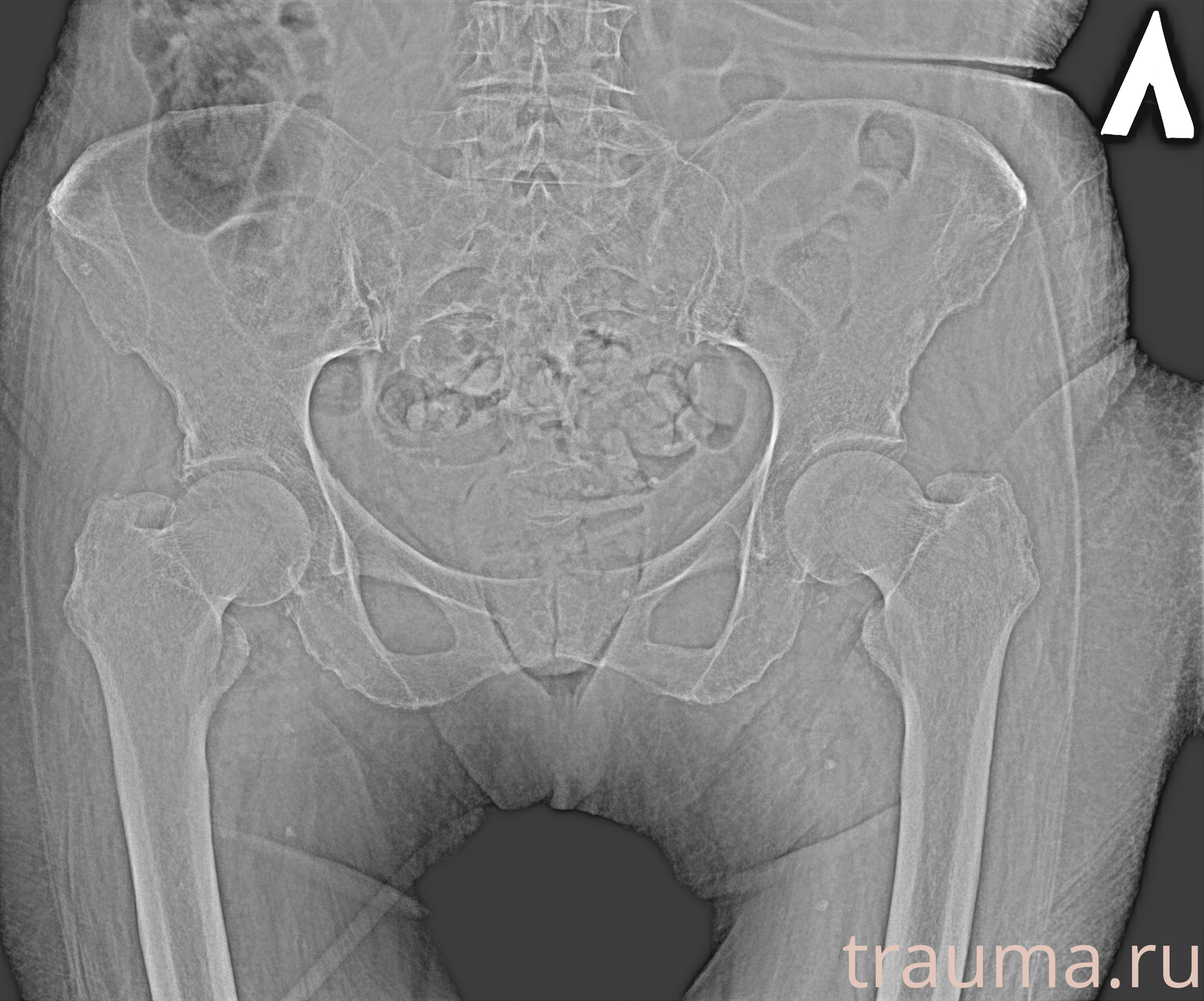 Рентген на дому: по вашему адресу приезжает врач-рентгенолог, травматолог-ортопед с мобильным рентгеновским аппаратом, проводит диагностику травмы или заболевания, делает необходимые рентгенограммы, дает рекомендации по дальнейшему лечению. Получить качественные снимки в домашних условиях возможно благодаря уникальной методике, разработанной МосРентген Центром для института  Склифосовского