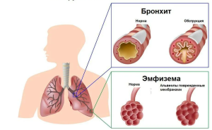 Курс медицинской рентгенологии. Рентгенодиагностика. Рентгенологическое исследование органов дыхания (легких и плевры).Часть 2. Глава 7.3 Курс медицинской рентгенологии. Рентгенодиагностика. Рентгенологическое исследование органов дыхания (легких и плевры).Часть 2. Глава 7.3