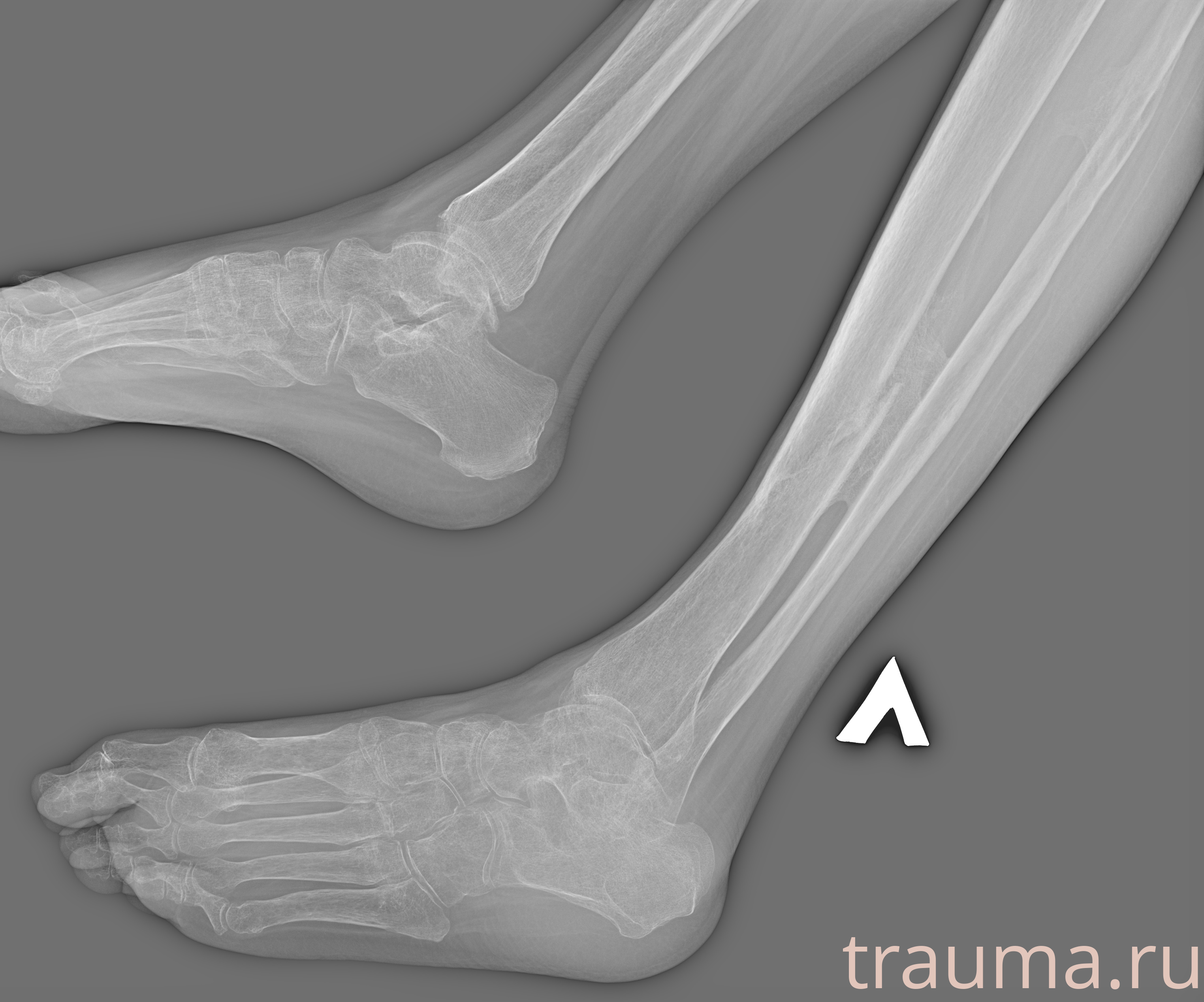 Рентген на дому: по вашему адресу приезжает врач-рентгенолог, травматолог-ортопед с мобильным рентгеновским аппаратом, проводит диагностику травмы или заболевания, делает необходимые рентгенограммы, дает рекомендации по дальнейшему лечению. Получить качественные снимки в домашних условиях возможно благодаря уникальной методике, разработанной МосРентген Центром для института  Склифосовского