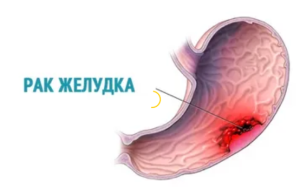 Рак желудка Рак желудка