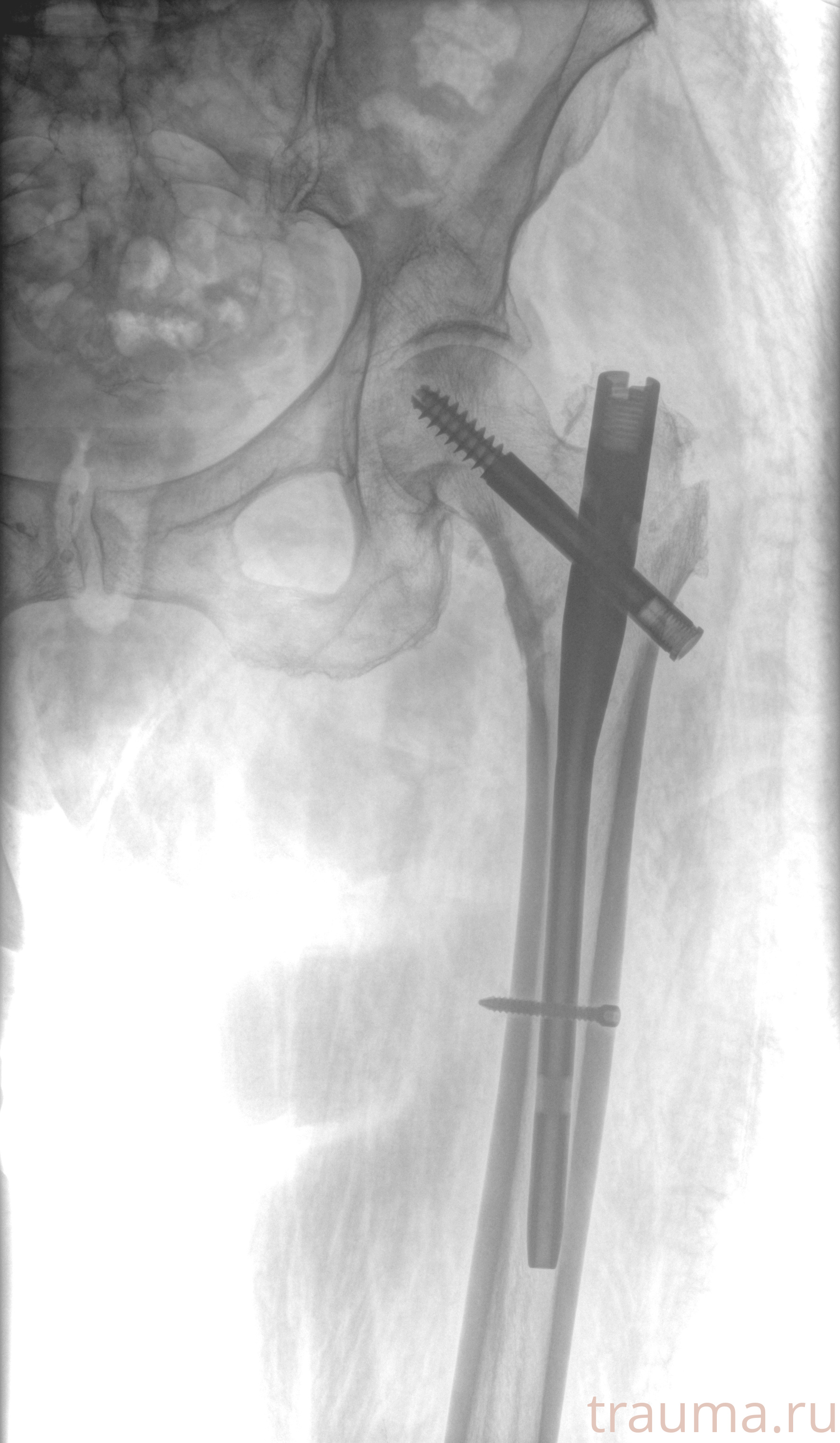 Рентген на дому: по вашему адресу приезжает врач-рентгенолог, травматолог-ортопед с мобильным рентгеновским аппаратом, проводит диагностику травмы или заболевания, делает необходимые рентгенограммы, дает рекомендации по дальнейшему лечению. Получить качественные снимки в домашних условиях возможно благодаря уникальной методике, разработанной МосРентген Центром для института  Склифосовского