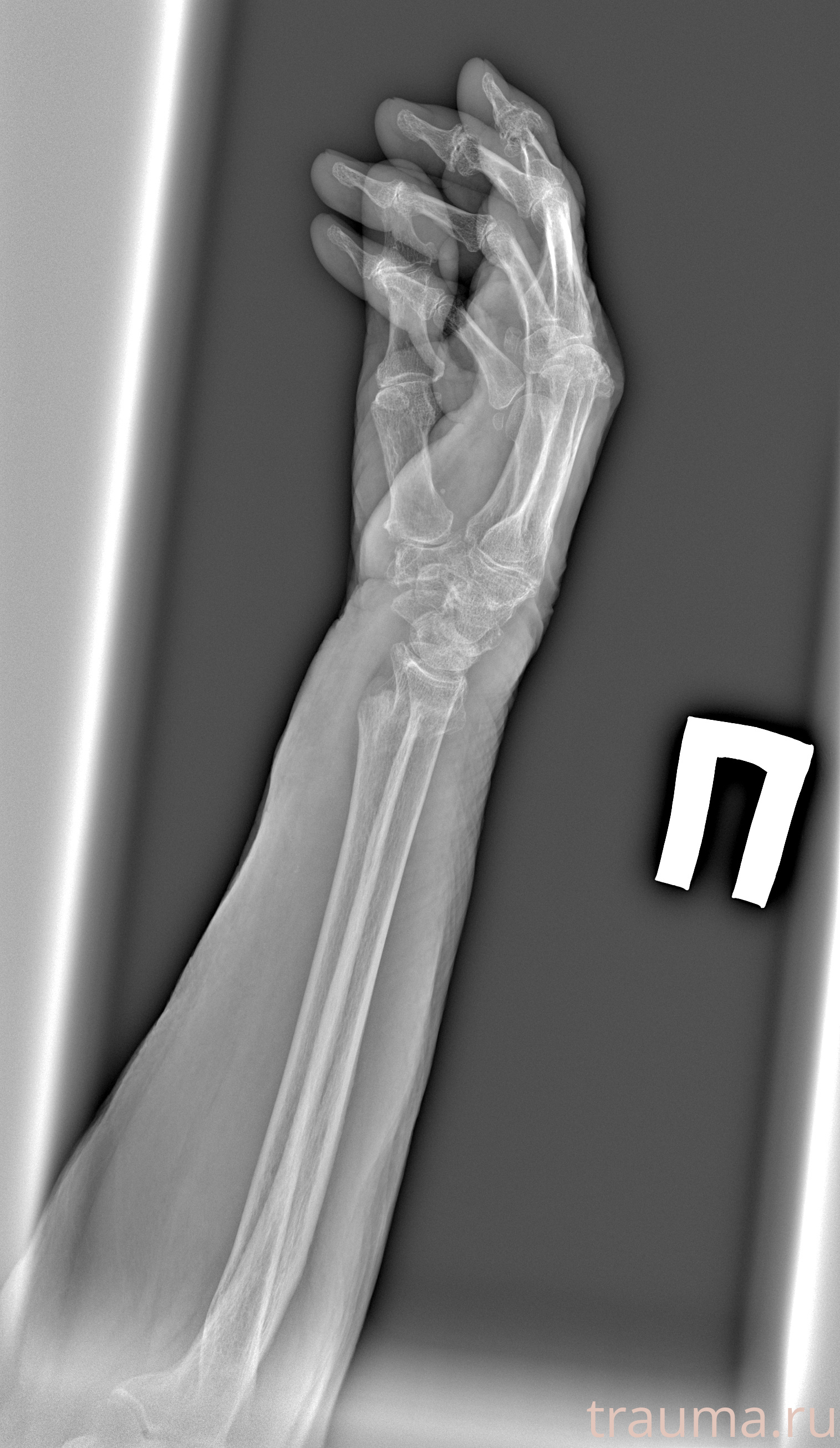 Рентген на дому: по вашему адресу приезжает врач-рентгенолог, травматолог-ортопед с мобильным рентгеновским аппаратом, проводит диагностику травмы или заболевания, делает необходимые рентгенограммы, дает рекомендации по дальнейшему лечению. Получить качественные снимки в домашних условиях возможно благодаря уникальной методике, разработанной МосРентген Центром для института  Склифосовского