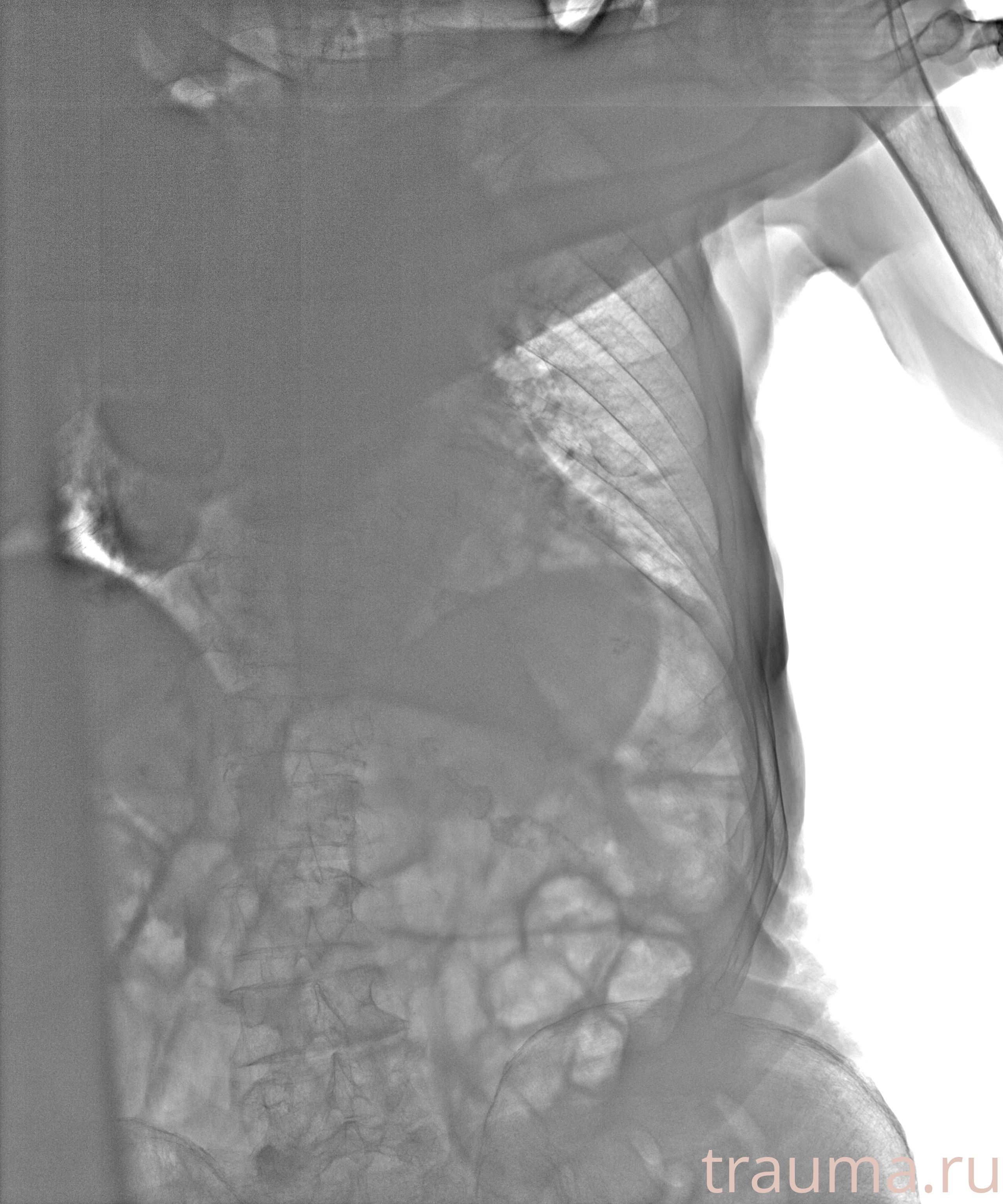 Рентген на дому: по вашему адресу приезжает врач-рентгенолог, травматолог-ортопед с мобильным рентгеновским аппаратом, проводит диагностику травмы или заболевания, делает необходимые рентгенограммы, дает рекомендации по дальнейшему лечению. Получить качественные снимки в домашних условиях возможно благодаря уникальной методике, разработанной МосРентген Центром для института  Склифосовского