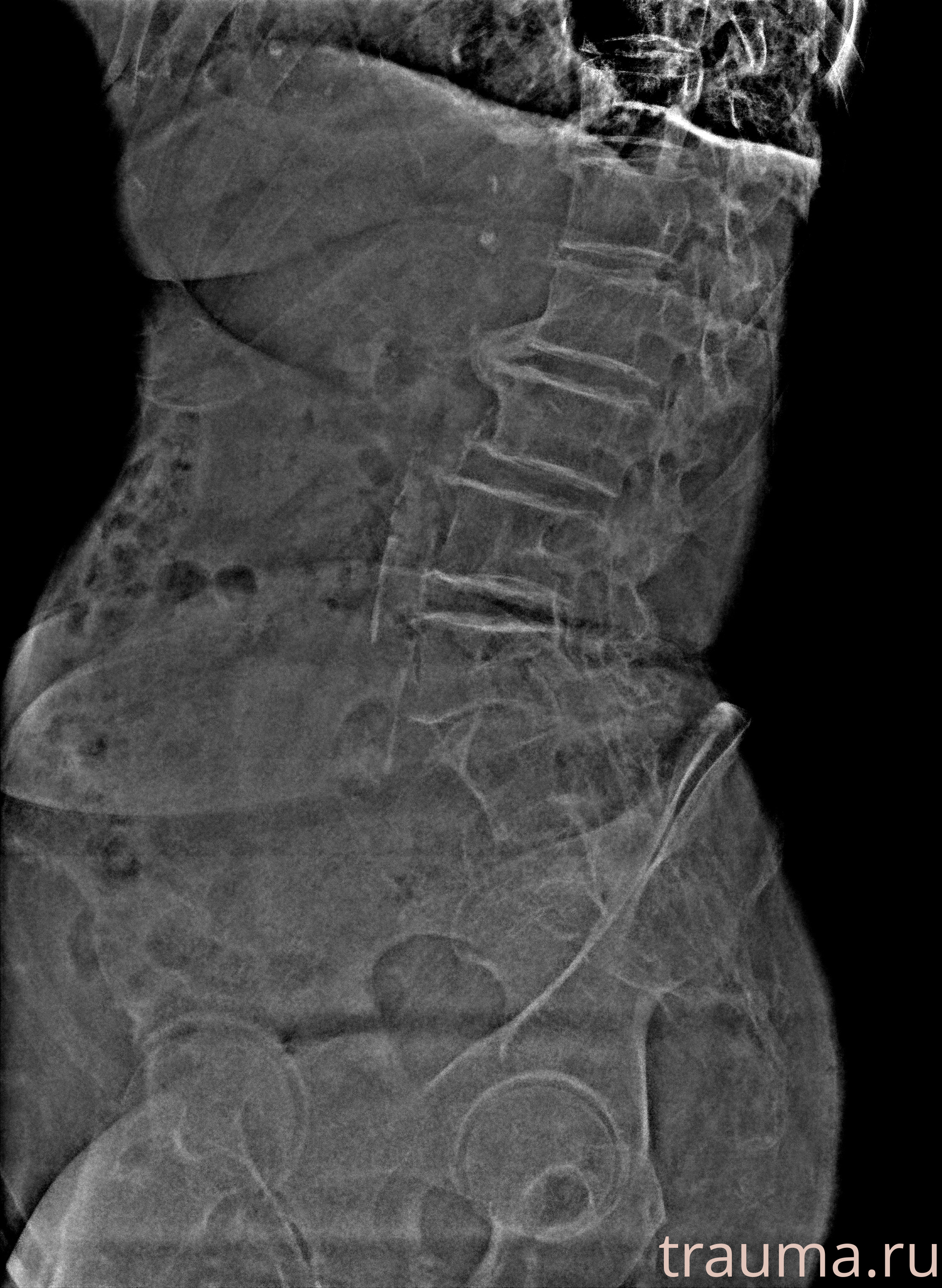 Рентген на дому: по вашему адресу приезжает врач-рентгенолог, травматолог-ортопед с мобильным рентгеновским аппаратом, проводит диагностику травмы или заболевания, делает необходимые рентгенограммы, дает рекомендации по дальнейшему лечению. Получить качественные снимки в домашних условиях возможно благодаря уникальной методике, разработанной МосРентген Центром для института  Склифосовского