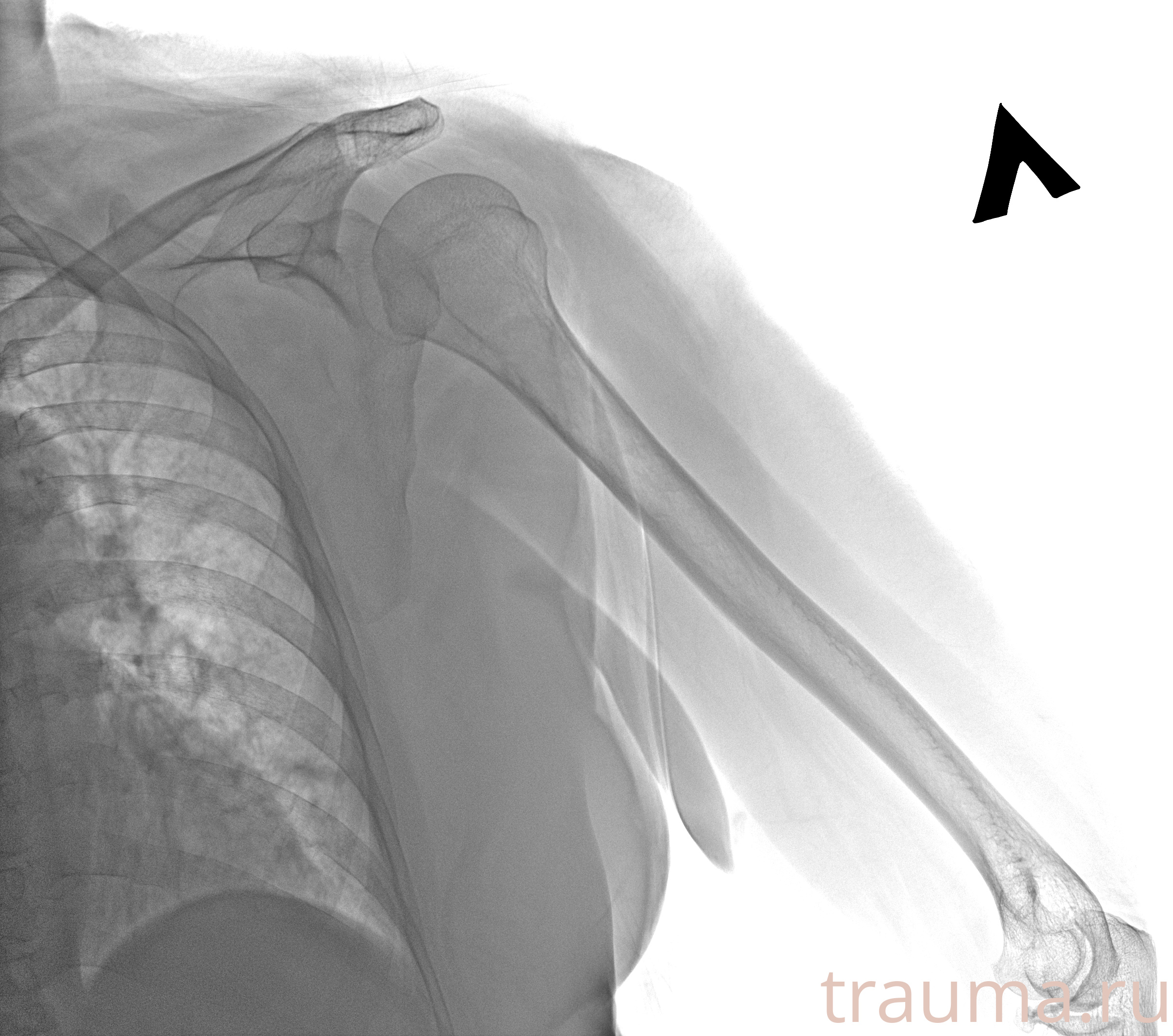 Рентген на дому: по вашему адресу приезжает врач-рентгенолог, травматолог-ортопед с мобильным рентгеновским аппаратом, проводит диагностику травмы или заболевания, делает необходимые рентгенограммы, дает рекомендации по дальнейшему лечению. Получить качественные снимки в домашних условиях возможно благодаря уникальной методике, разработанной МосРентген Центром для института  Склифосовского