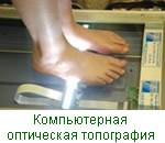 Компьютерно-оптическая топография как метод лучевой диагностики статических деформаций стоп у детей Компьютерно-оптическая топография как метод лучевой диагностики статических деформаций стоп у детей