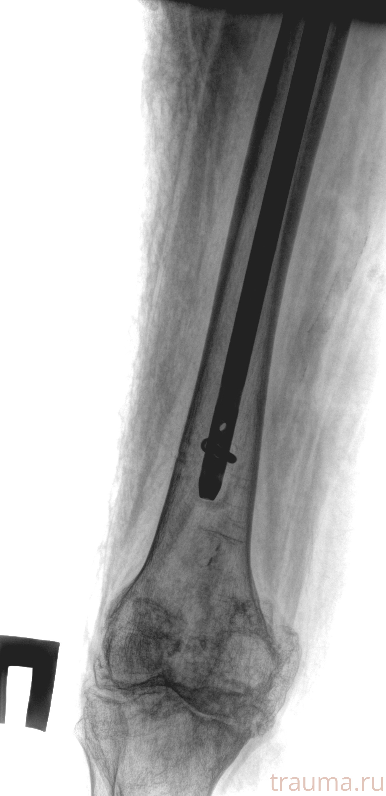 Рентген на дому: по вашему адресу приезжает врач-рентгенолог, травматолог-ортопед с мобильным рентгеновским аппаратом, проводит диагностику травмы или заболевания, делает необходимые рентгенограммы, дает рекомендации по дальнейшему лечению. Получить качественные снимки в домашних условиях возможно благодаря уникальной методике, разработанной МосРентген Центром для института  Склифосовского