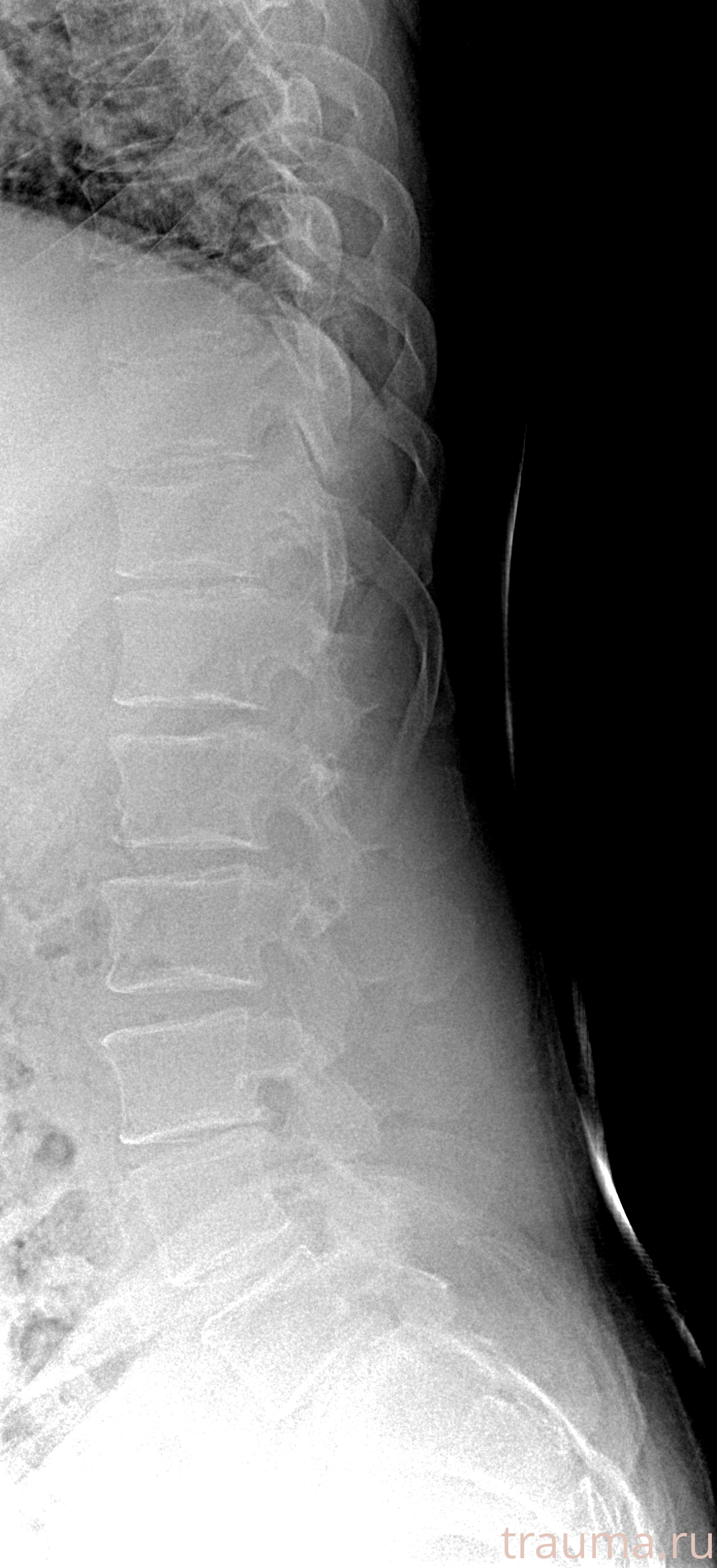 Рентген на дому: по вашему адресу приезжает врач-рентгенолог, травматолог-ортопед с мобильным рентгеновским аппаратом, проводит диагностику травмы или заболевания, делает необходимые рентгенограммы, дает рекомендации по дальнейшему лечению. Получить качественные снимки в домашних условиях возможно благодаря уникальной методике, разработанной МосРентген Центром для института  Склифосовского