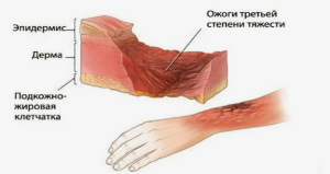 Способ прогноза исхода ожоговой травмы на основе математической модели Способ прогноза исхода ожоговой травмы на основе математической модели