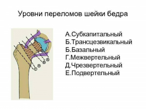 Оперативное лечение чрезвертельного перелома бедренной кости Оперативное лечение чрезвертельного перелома бедренной кости