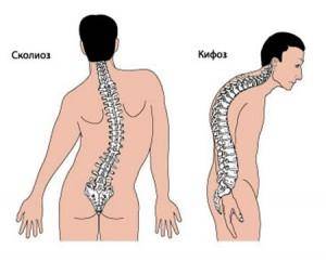 Кифосколиоз Кифосколиоз